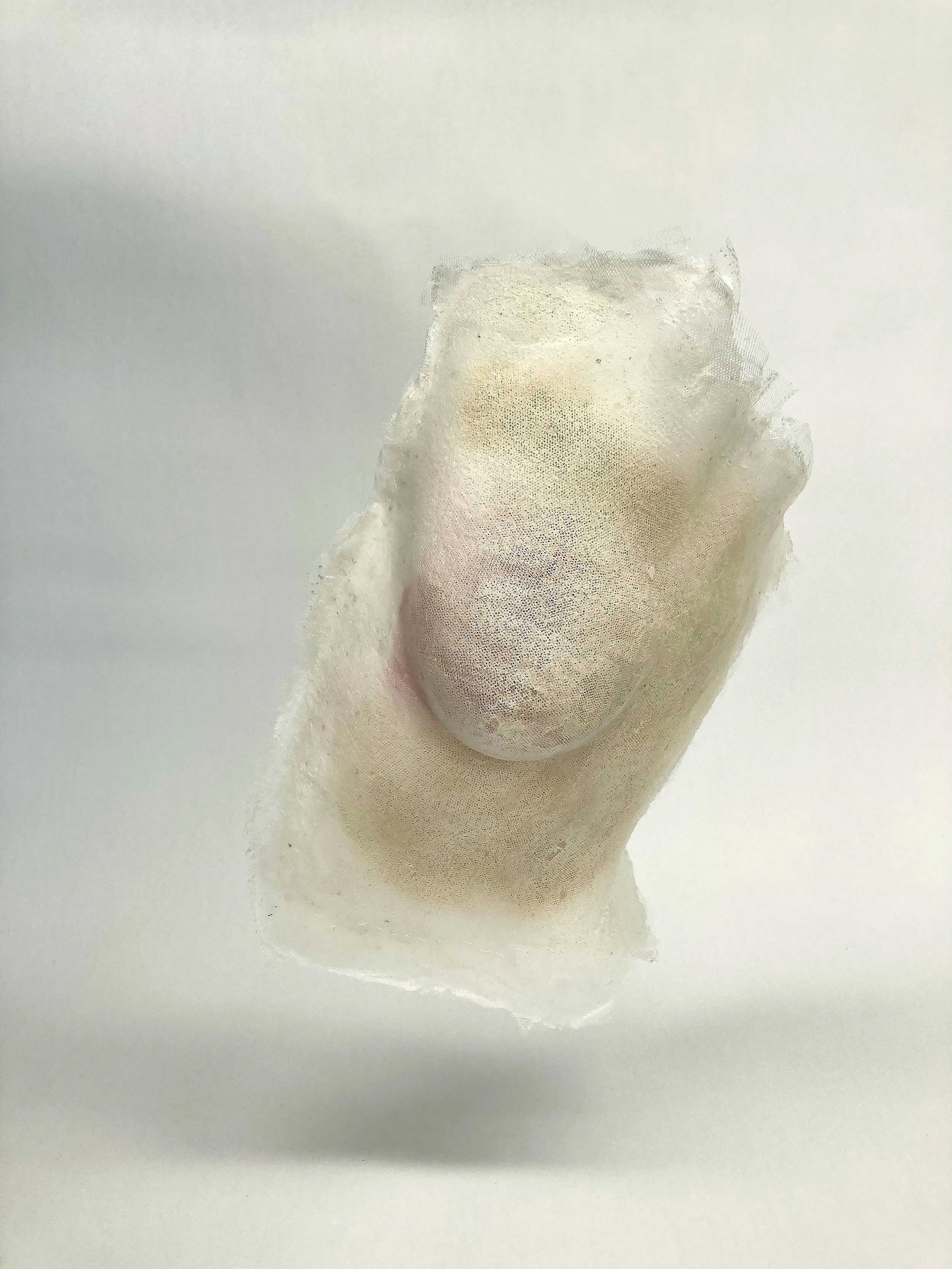 5breasttumor.jpg