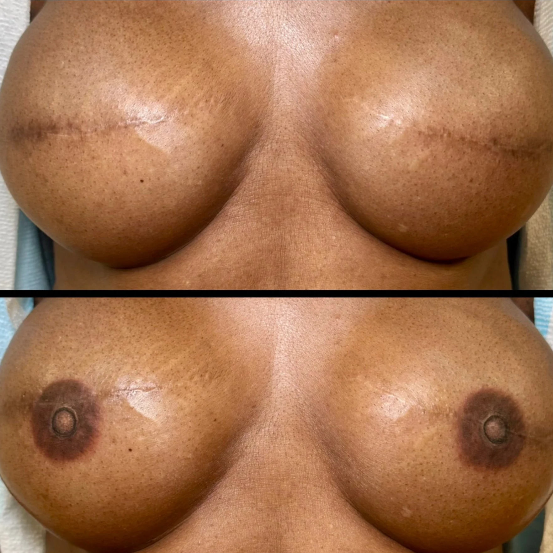 3D Areola Images