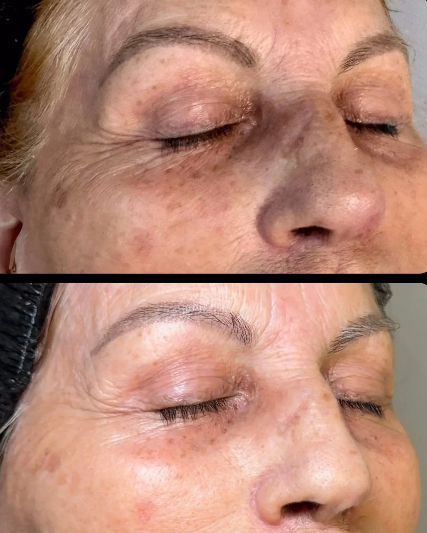 Procell Skin Microchanneling Images