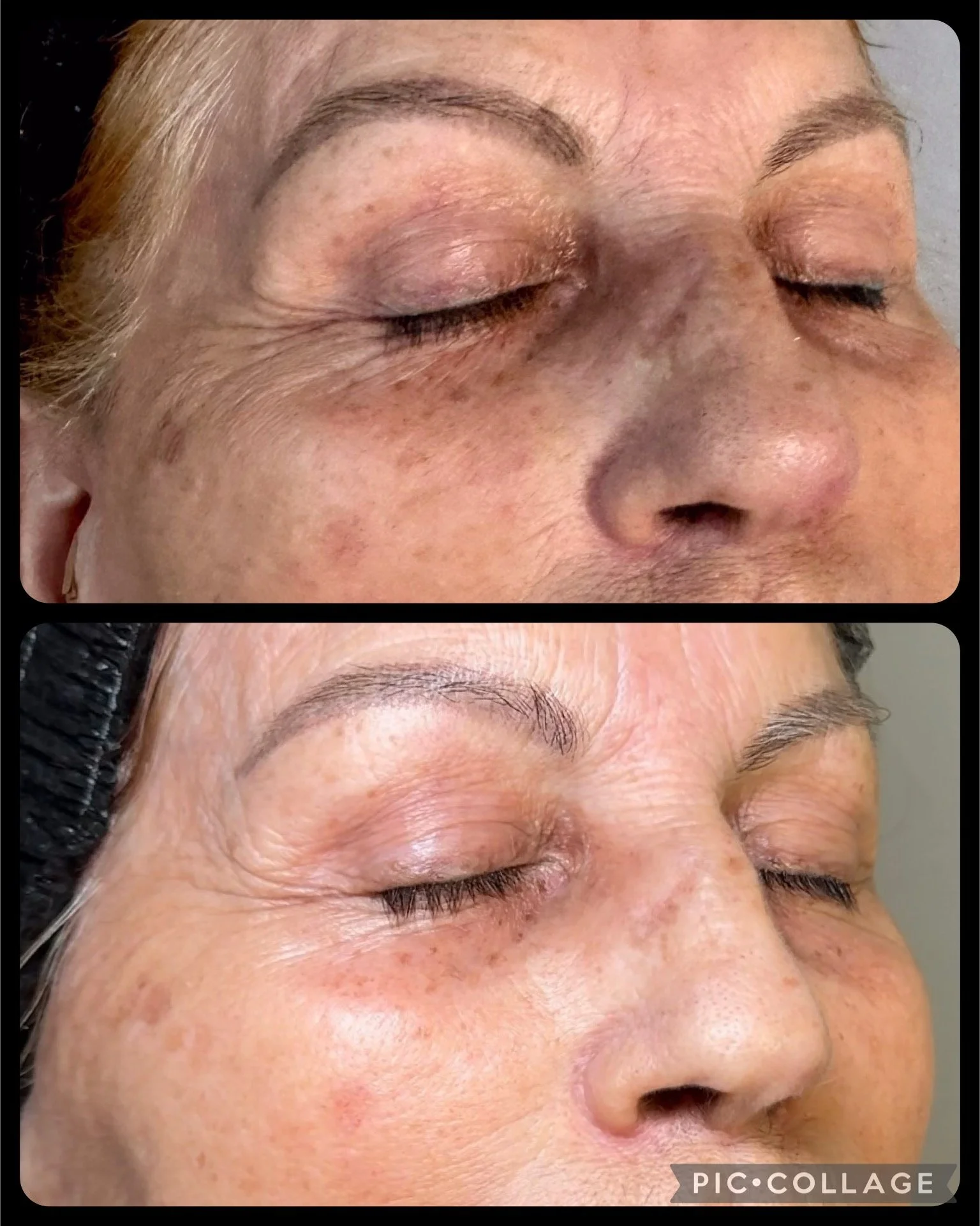 After just 1 Procell treatment!