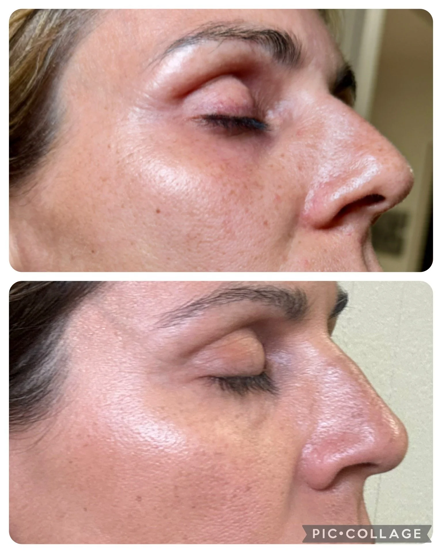 After just 1 Procell treatment!