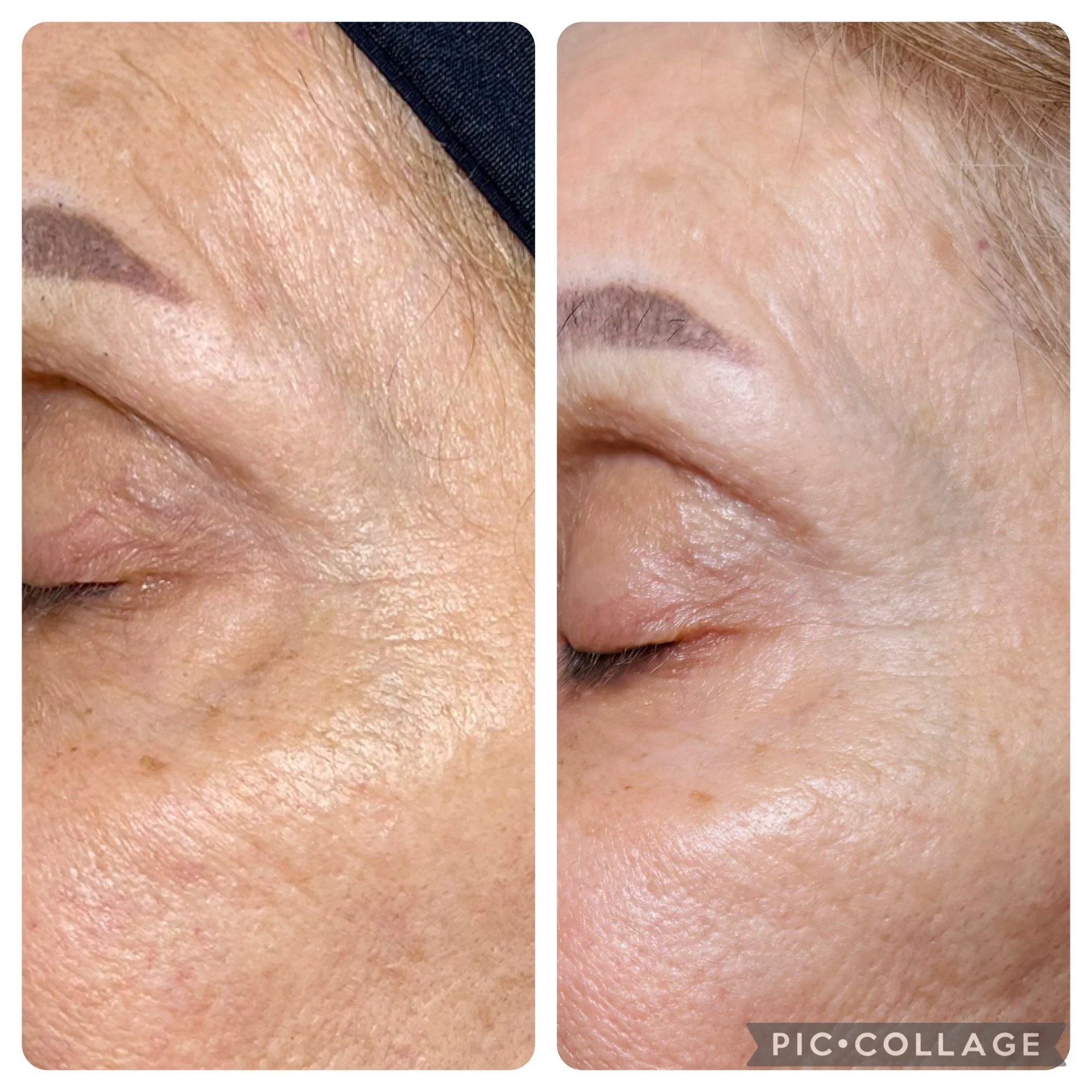 After just 1 Procell treatment!