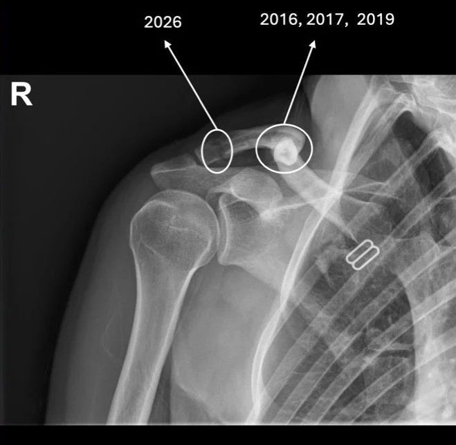 I guess 2026 really decided to start with a bang 💥

Broke my collarbone. Again.

Fourth time.
Same collarbone.
Different location this time.

I&rsquo;m clearly building a collection now. 🥴

Now on a serious note:

Right in prime season, after a pre