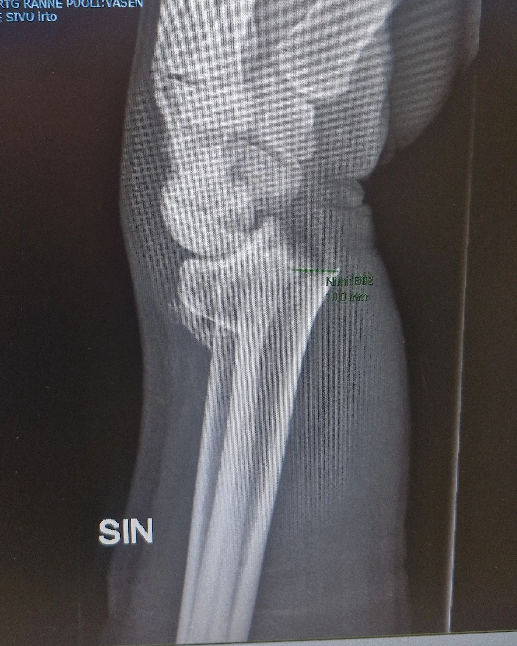 Yksinyrittäjän tapaturma – katastrofi vai suuri mahdollisuus?