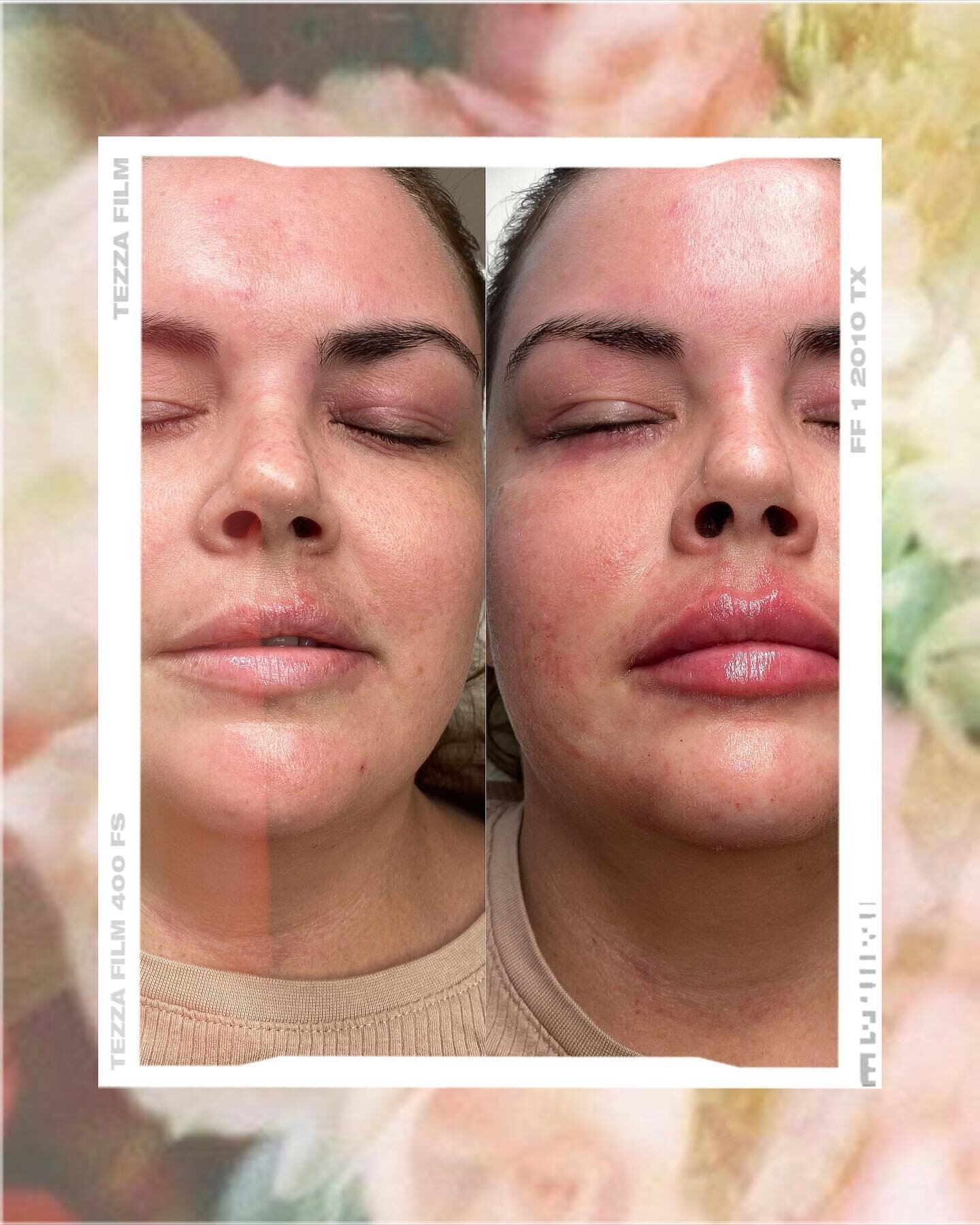 Facial balancing with lip filler on a first time, lip filler client 🤍 I aimed to create definition and a symmetrical shape for this lovely clients lips 🤍