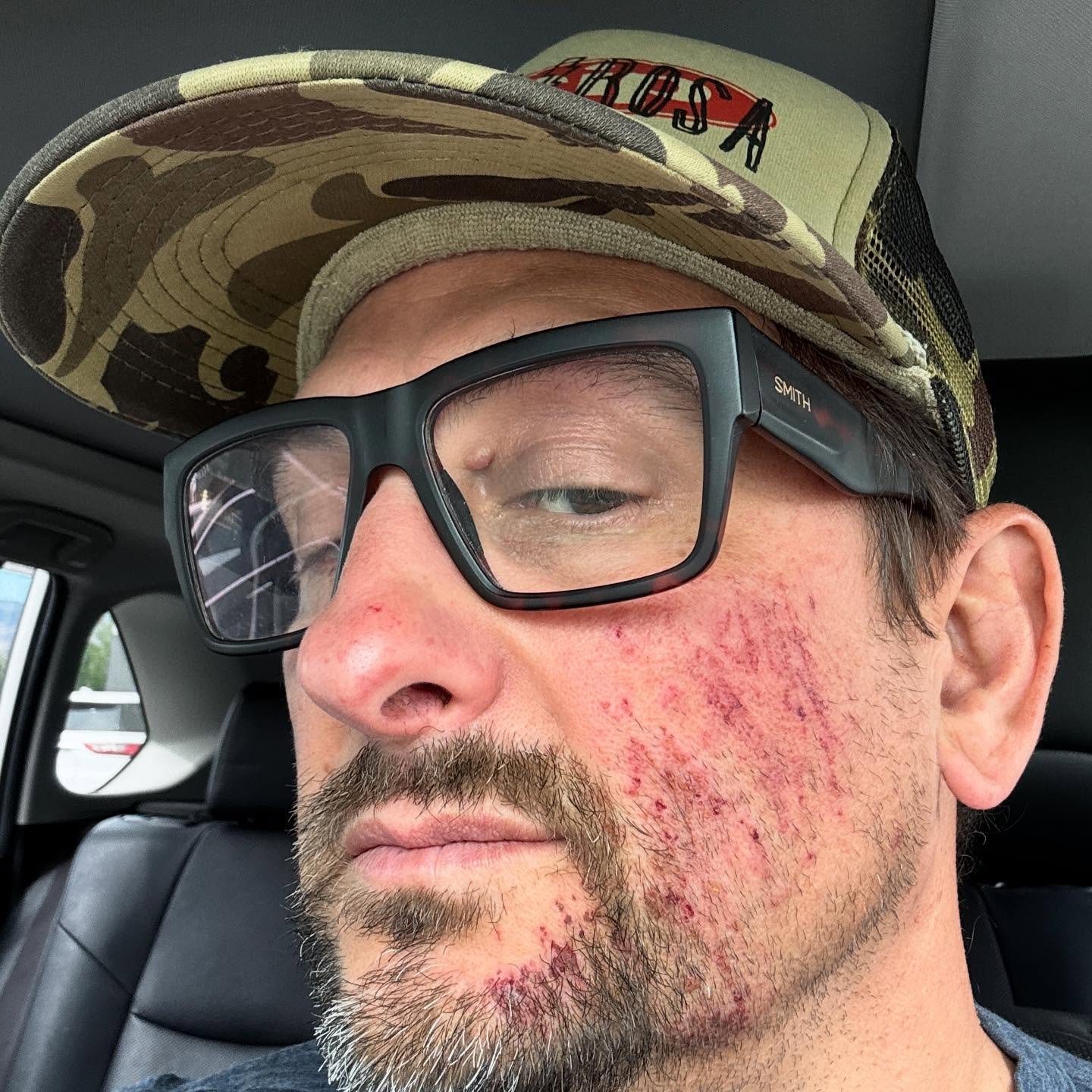 What started as a great morning getting ready for @lostandfoundbikeride ended with a ride in the sag wagon. I crashed on a decent and hit my head, for safety protocol&rsquo;s the race team pulled me from the race. Thank you @lazersportna for saving m