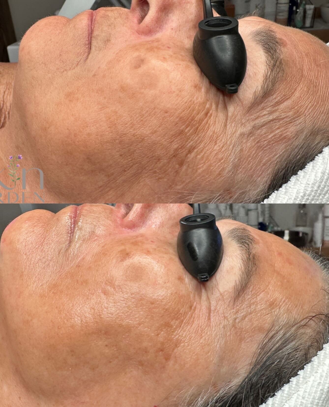 We literally shaved years 🤩 off of her skin today, with the power of my magical hands 🤗, Professional Korean Skin Care and the amazing Korean treatment Vtox ! ✨🫶🏼 

V-Tox  is a peptide-packed ultra lifting and firming treatment and is a natural a