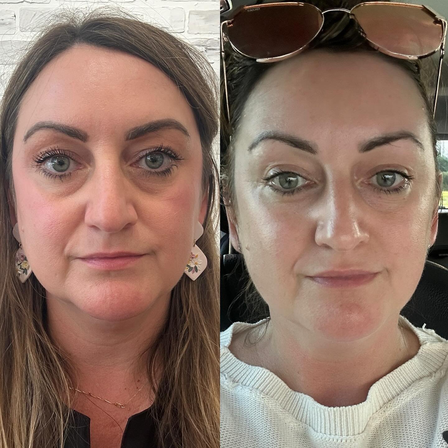 Another ✨NEW✨
 facial is on the way 😏. 
*no filter on either picture.*

Jowls drastically improved, fluid drained from nose and sinuses (it looks like I had an actual nose job, but nope just a new treatment on the way! ) Who knew you could carry so 