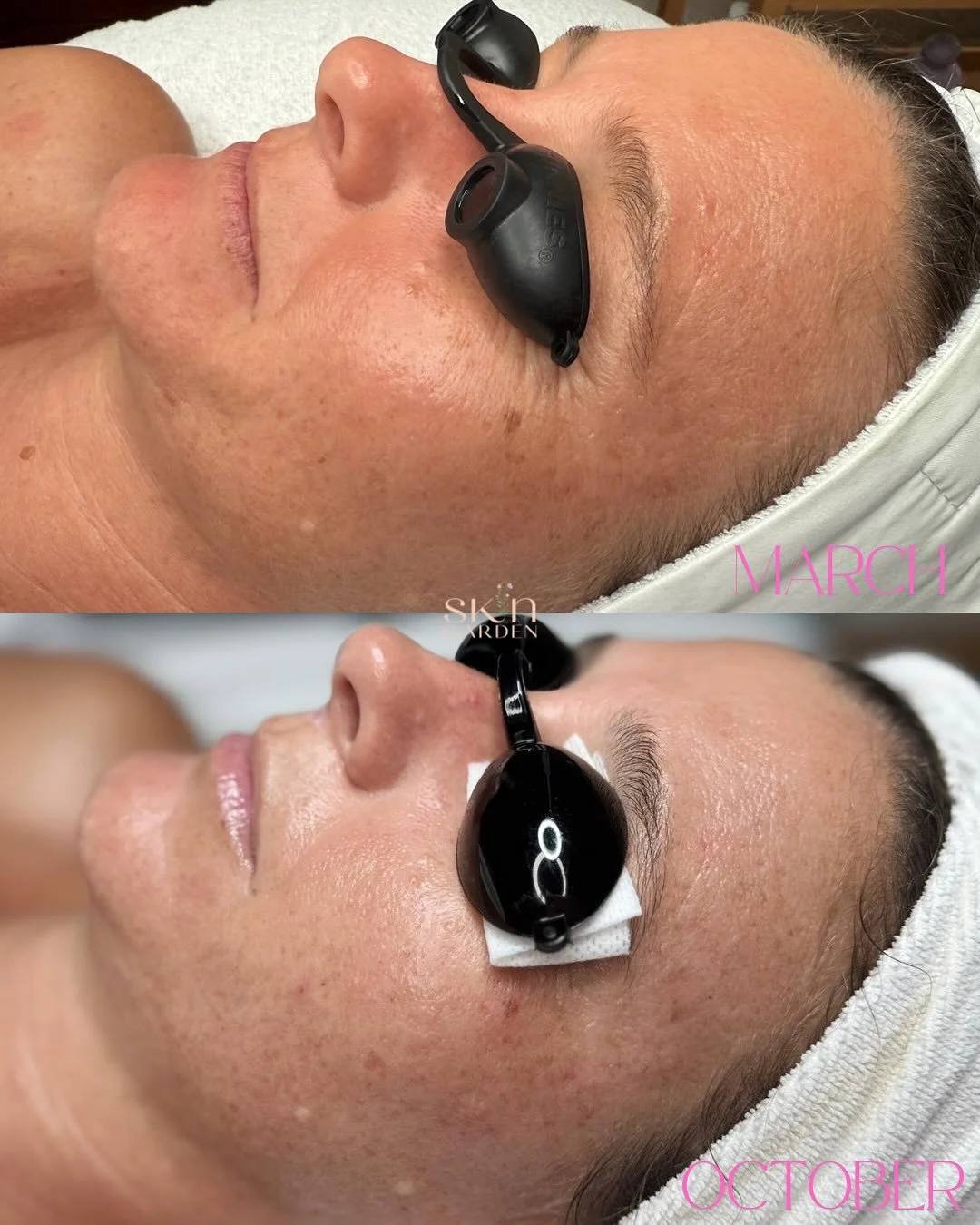 What a beautiful 7 month transformation for this baddie 💅🏽. We targeted redness, sun damage, and textured skin. 😎
We all want the magical one and done results, but the real trick is consistency with your facial treatments, high quality skin care a