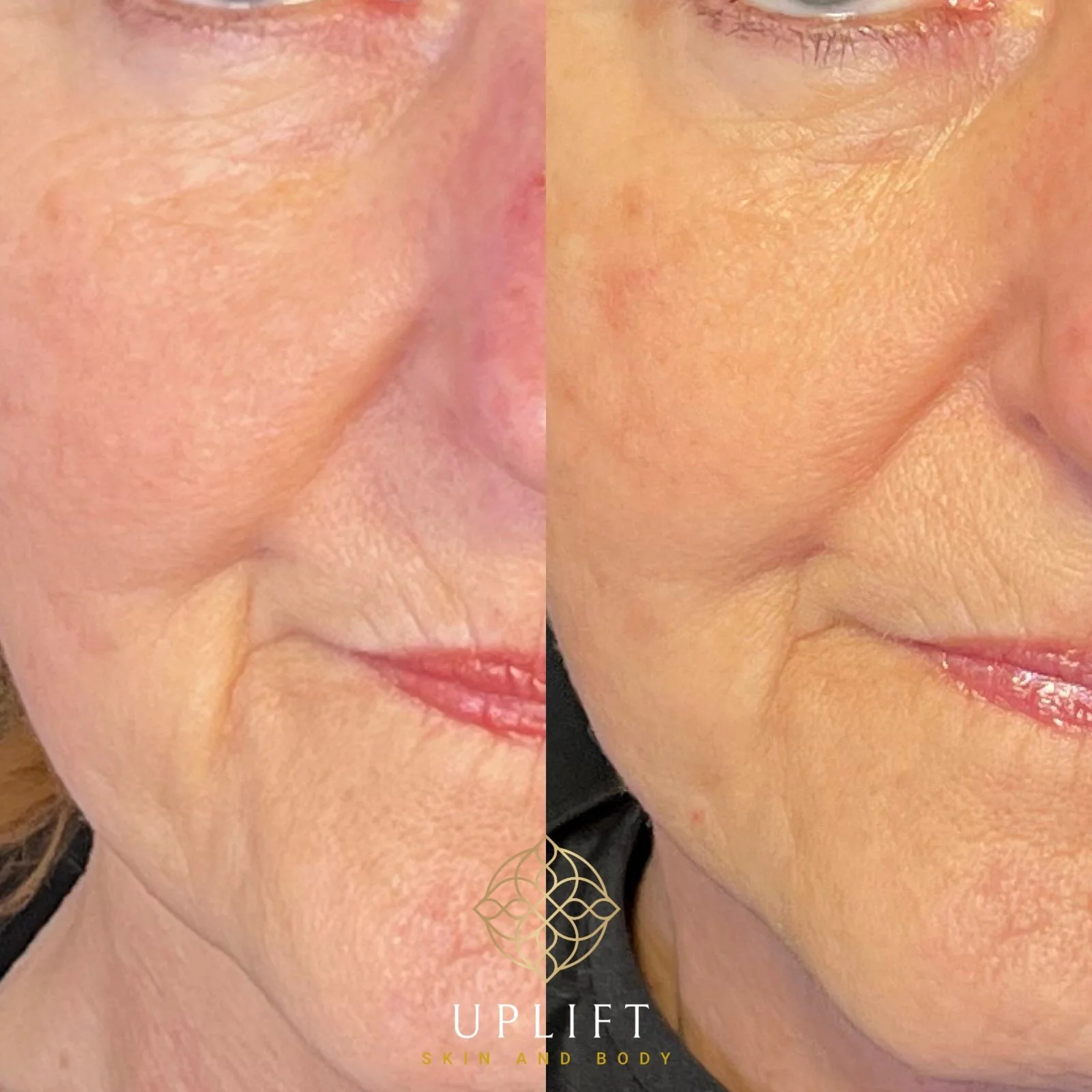 The Benefits of IPL for Sun Damage and Hyperpigmentation