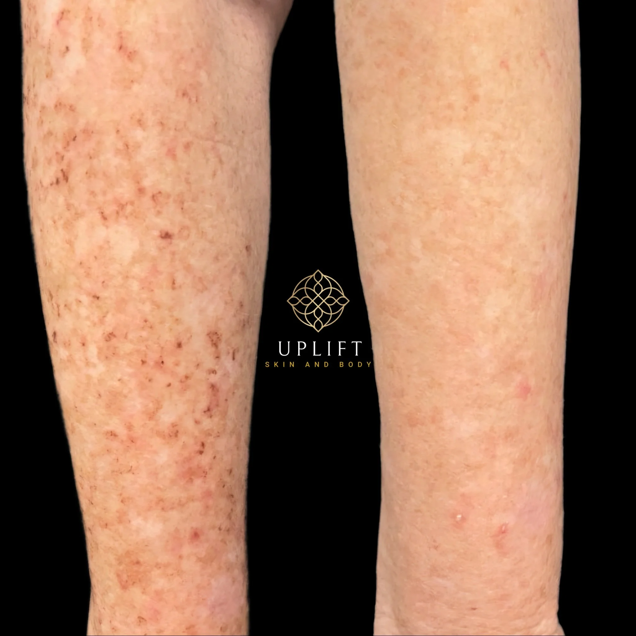 How Many IPL Treatments Are Needed for Best Results?