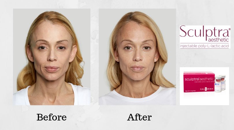 sculptra-aesthetic-before-and-after-photo1.jpg