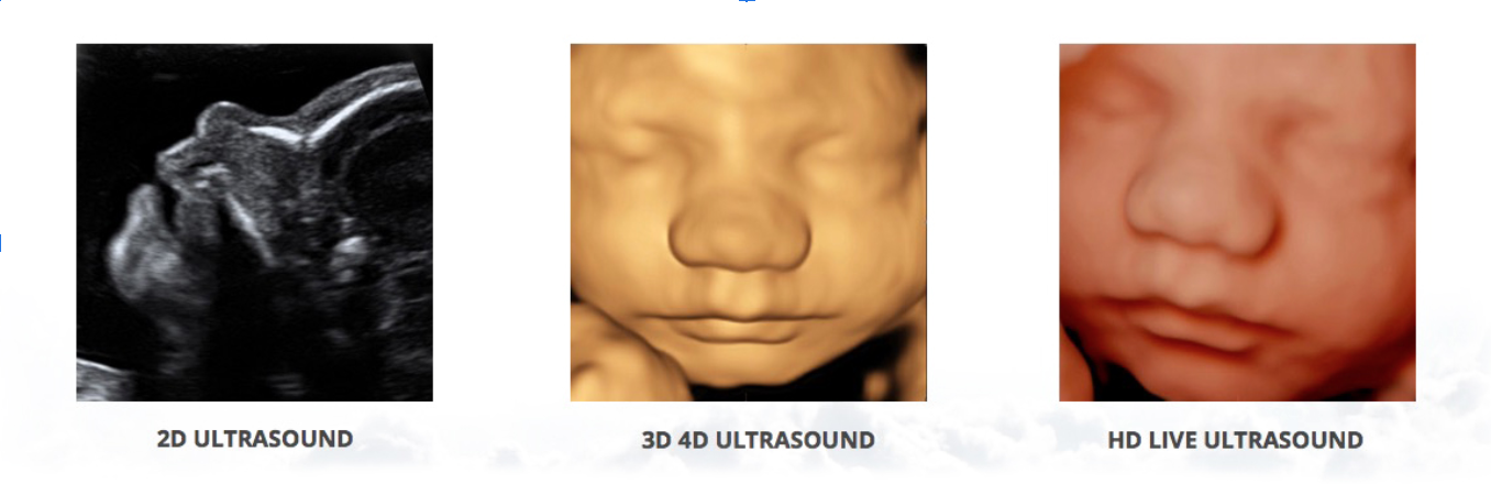 Sonogram Types FAQ | Get Answers Here — Elite Ultrasound Imaging | 3D/4D, OB/GYN ...