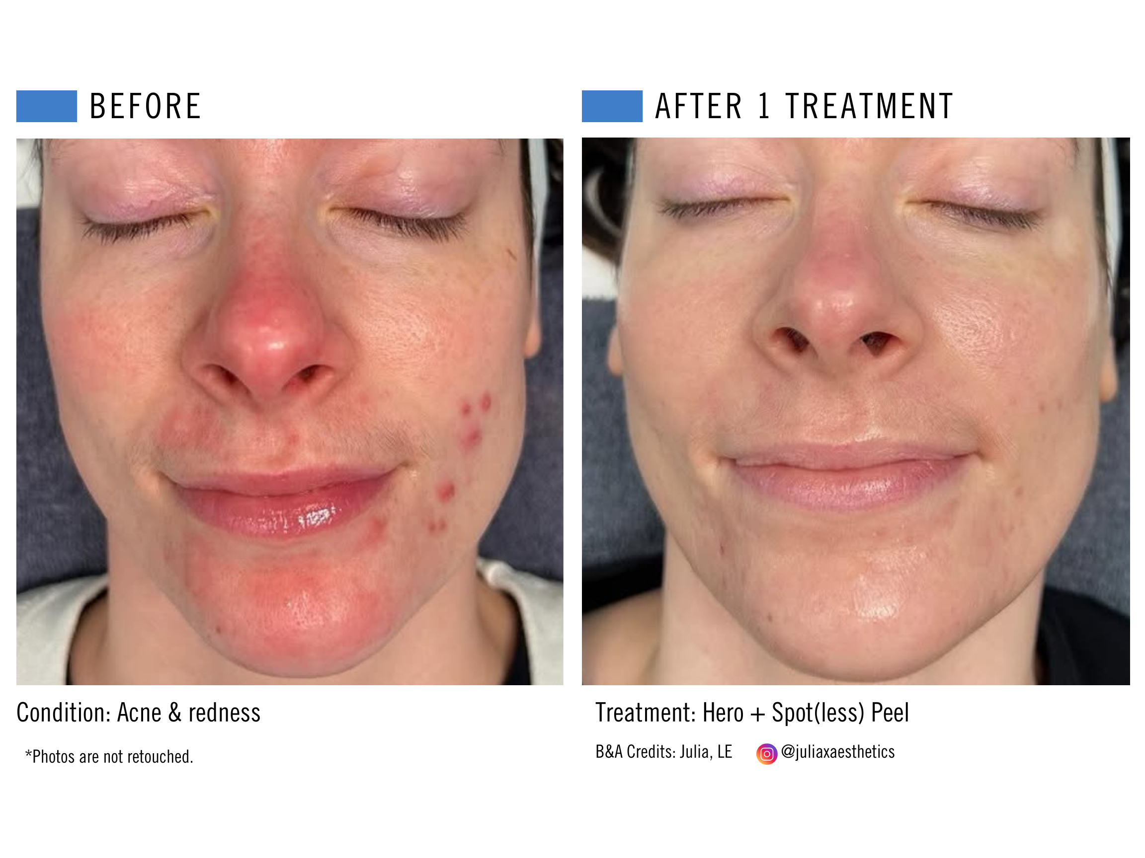 Hero + Spot(less) Peel.png