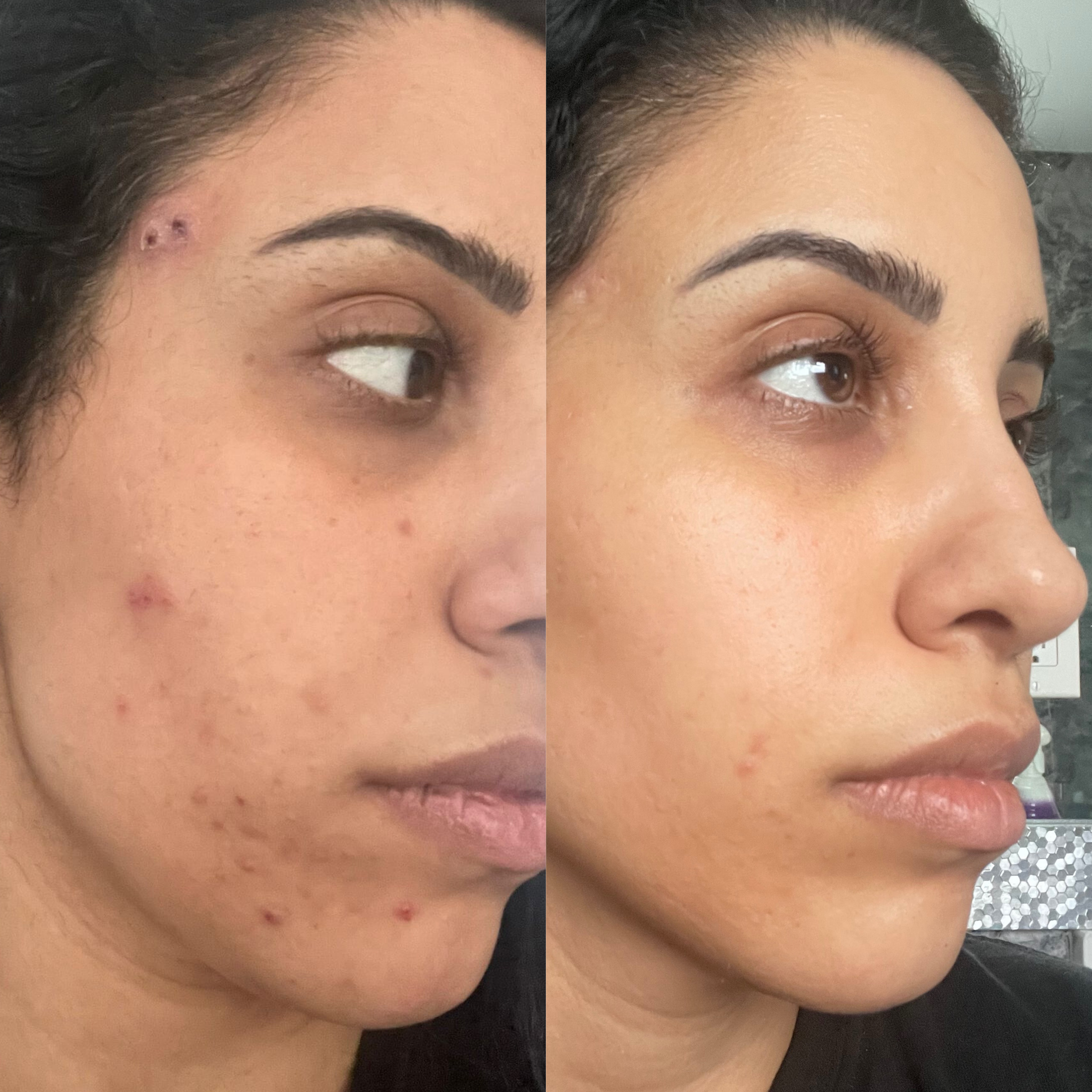 chemical peels x facials x microneedling