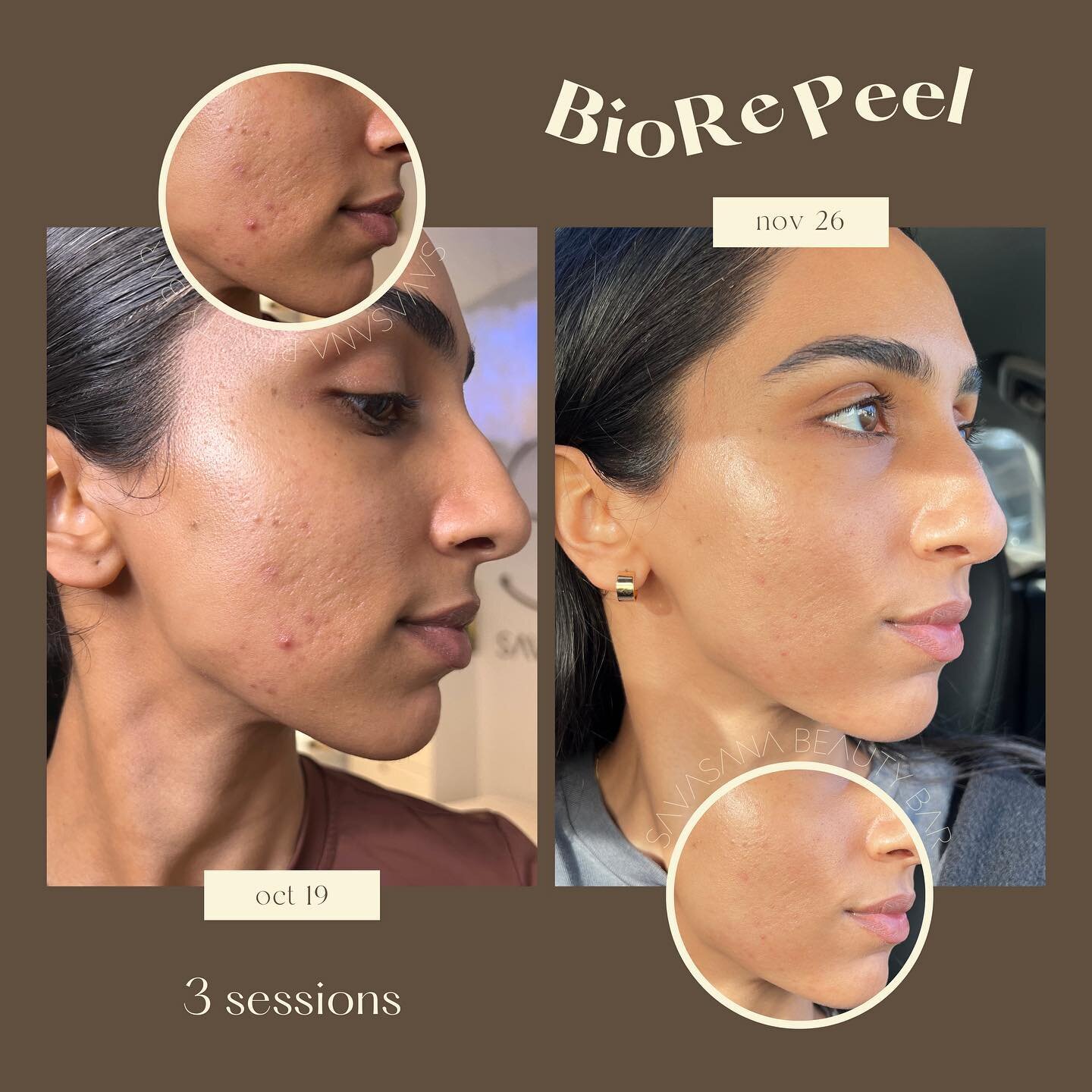 embarking on my biorepeel journey has been truly transformative. 🌟 this 35% tca peel from italy is a skincare game-changer, delivering remarkable results with minimal disruption to daily life. 

👈🏽the photo on the left marks the beginning of my bi