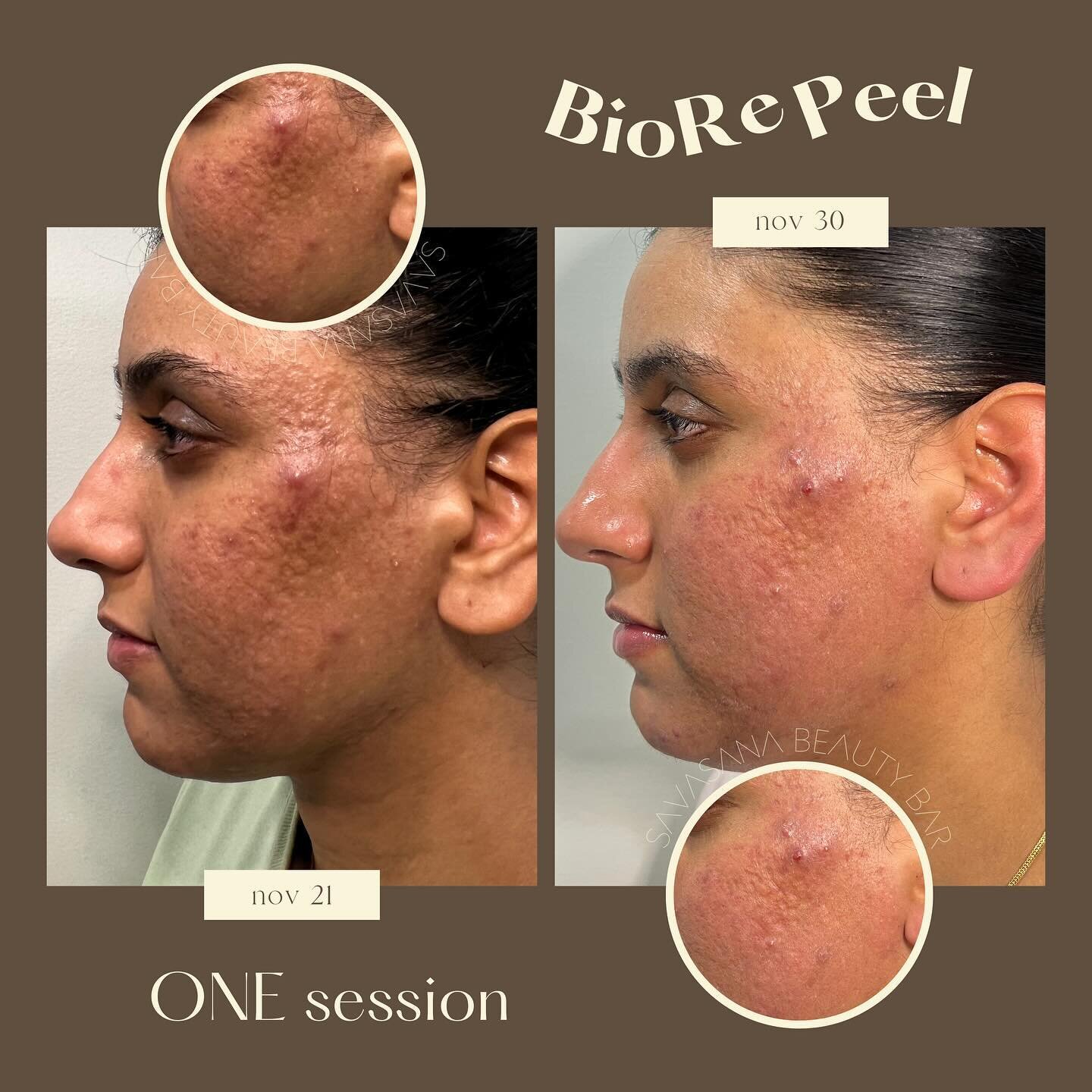 can we just take a second to SCREAM about these results?! 😱✨ jaw-dropping glow-up after just ONE BioRepeel session, spaced ten days apart! 🌟 patiently waiting to see the results after her 4-6 sessions, completed just a few weeks from now. 

how did