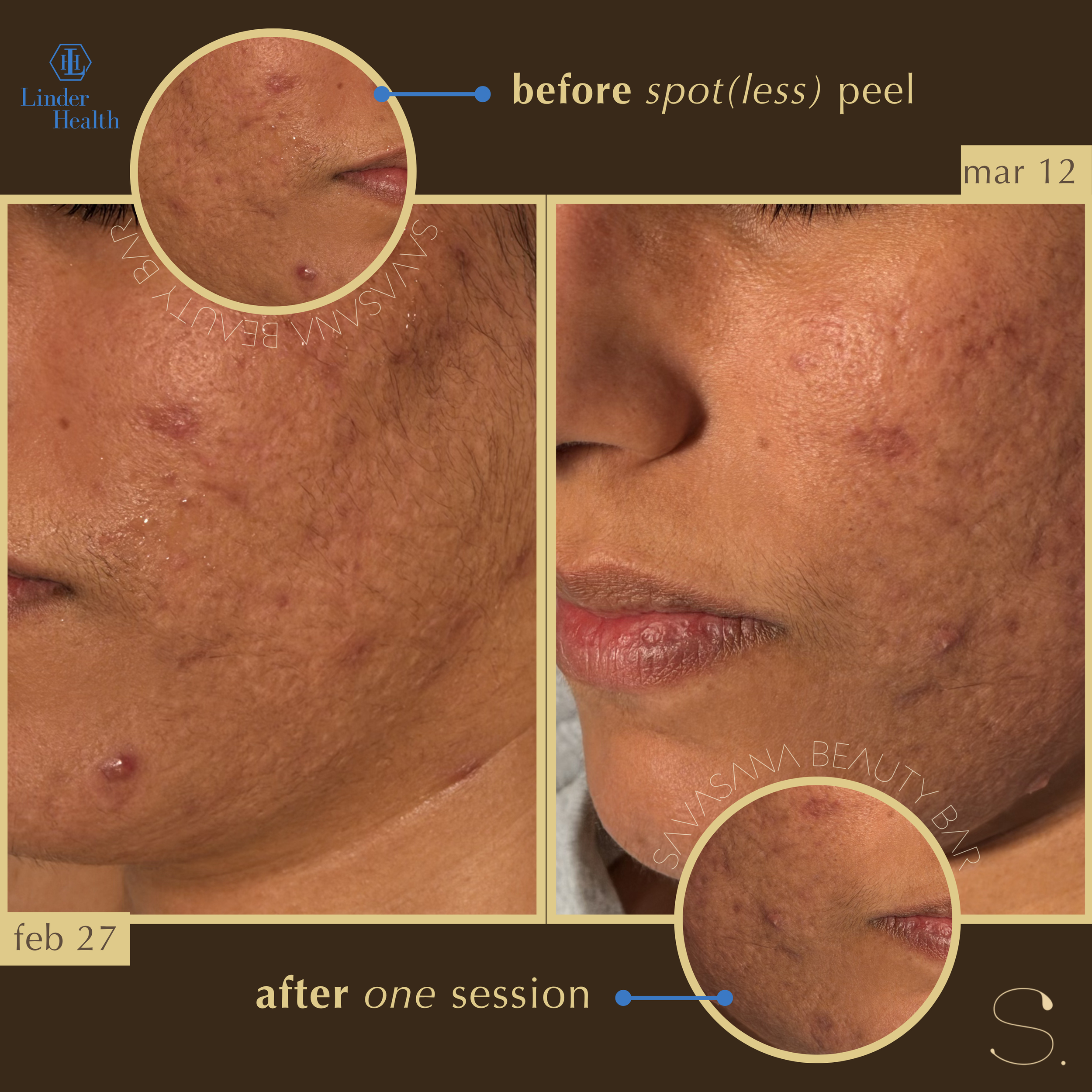 chemical peels x facials