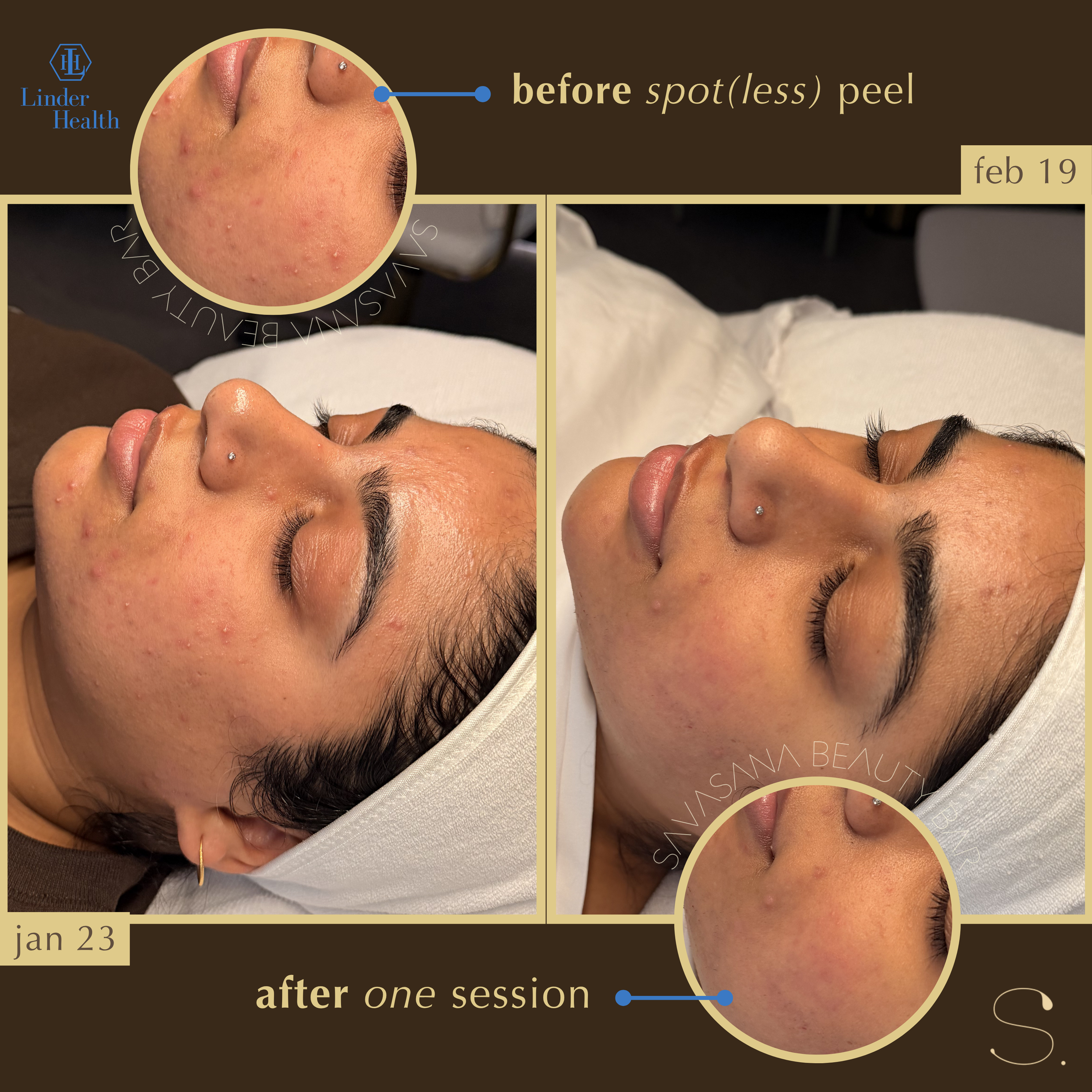 chemical peels x facials