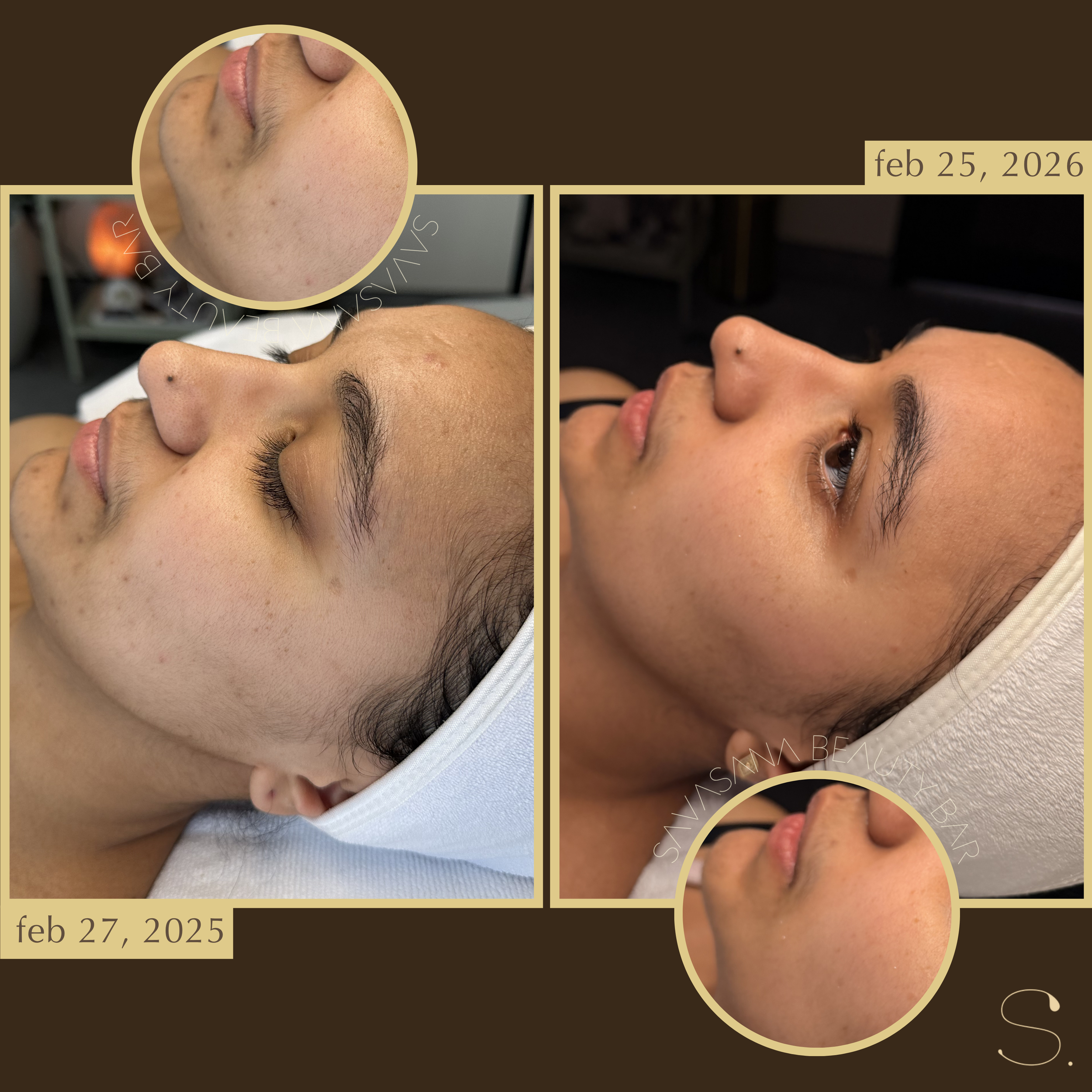 chemical peels x facials