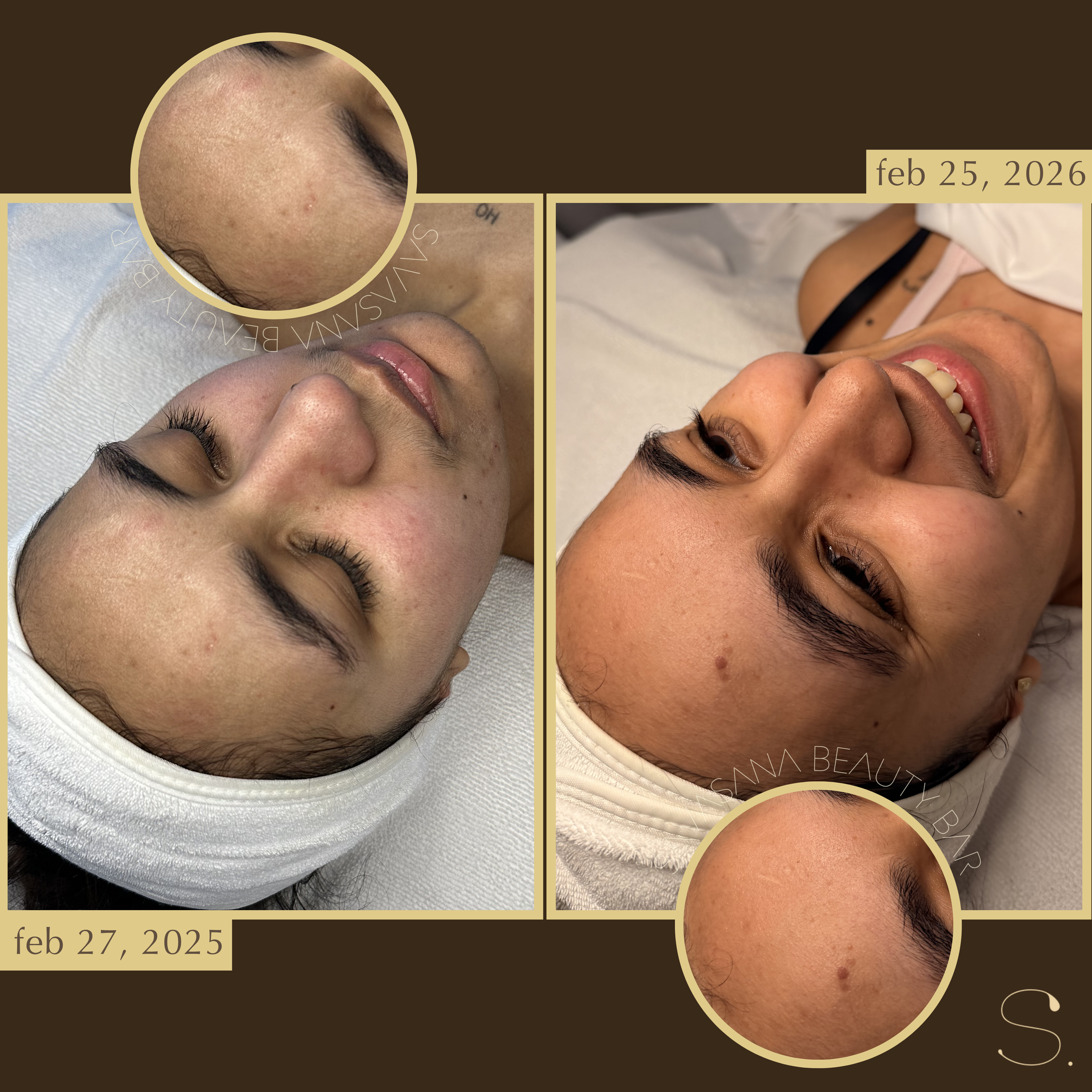 facials x chemical peels