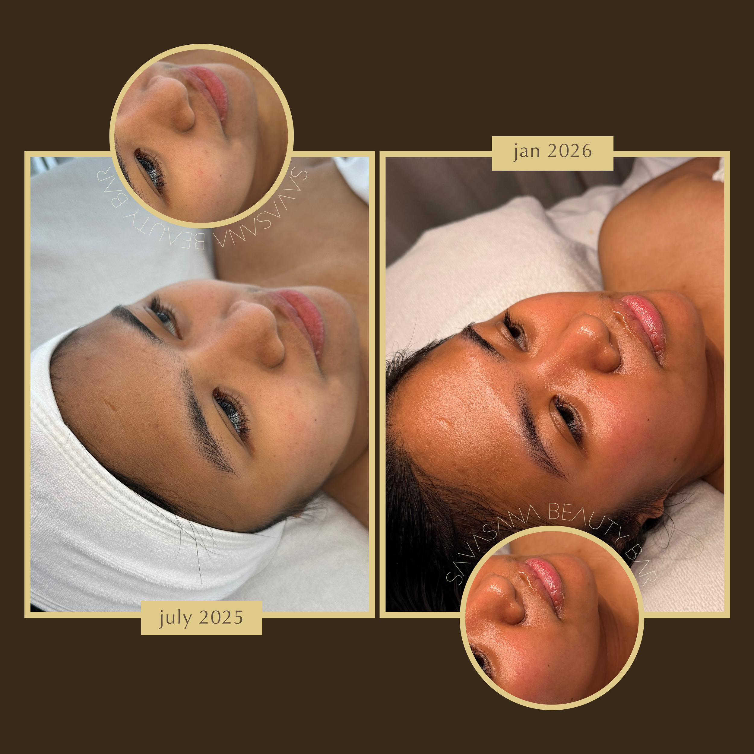 facials