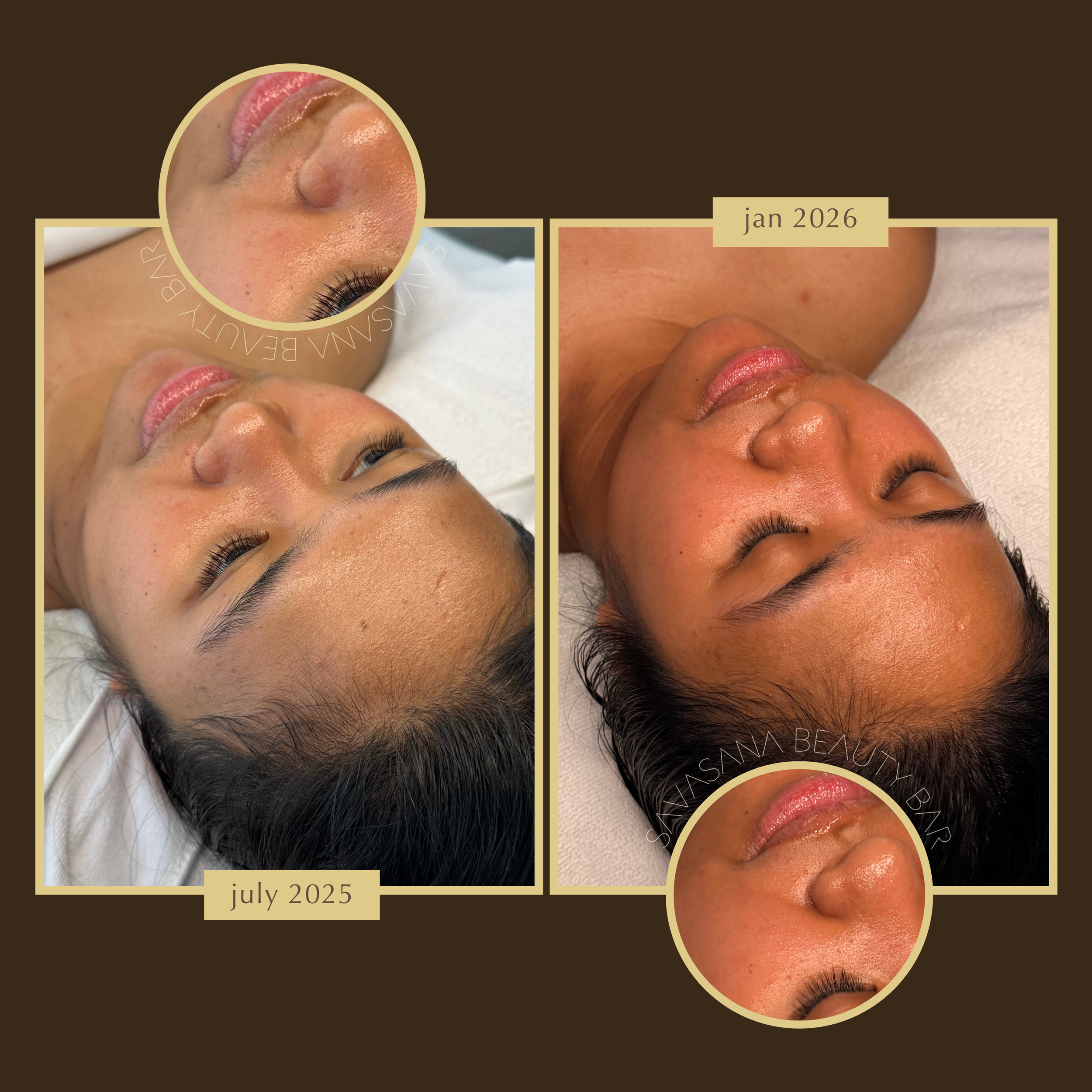 facials