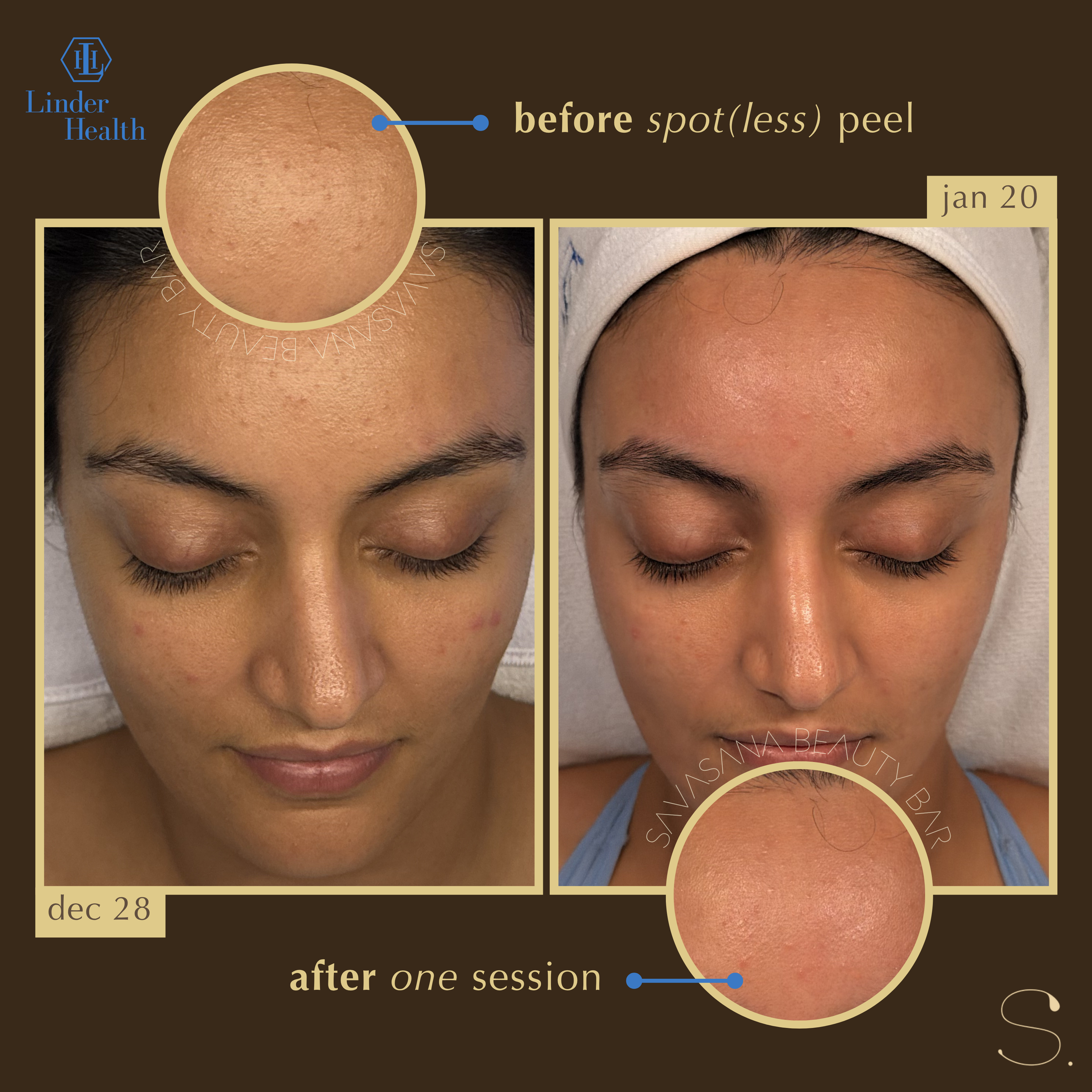 chemical peels x facials