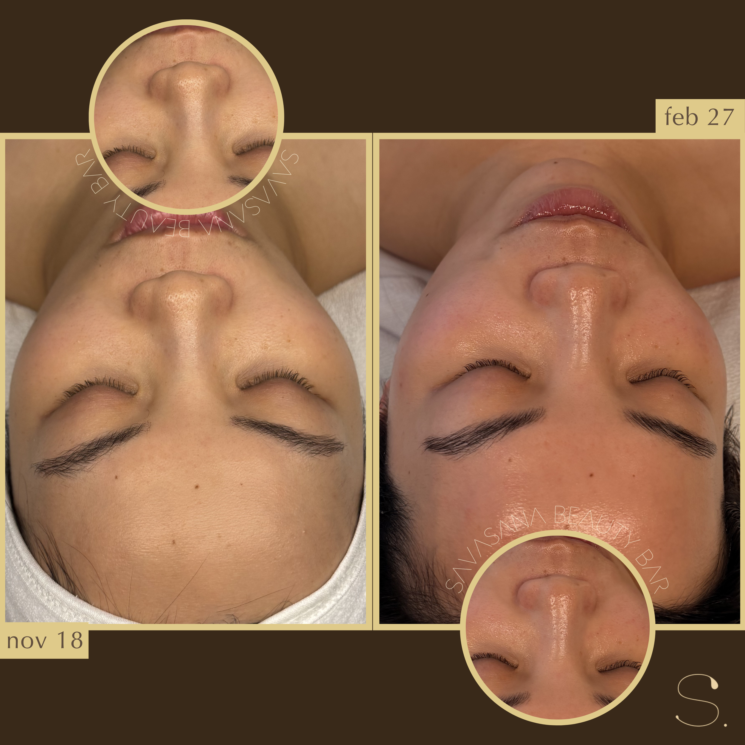 facials