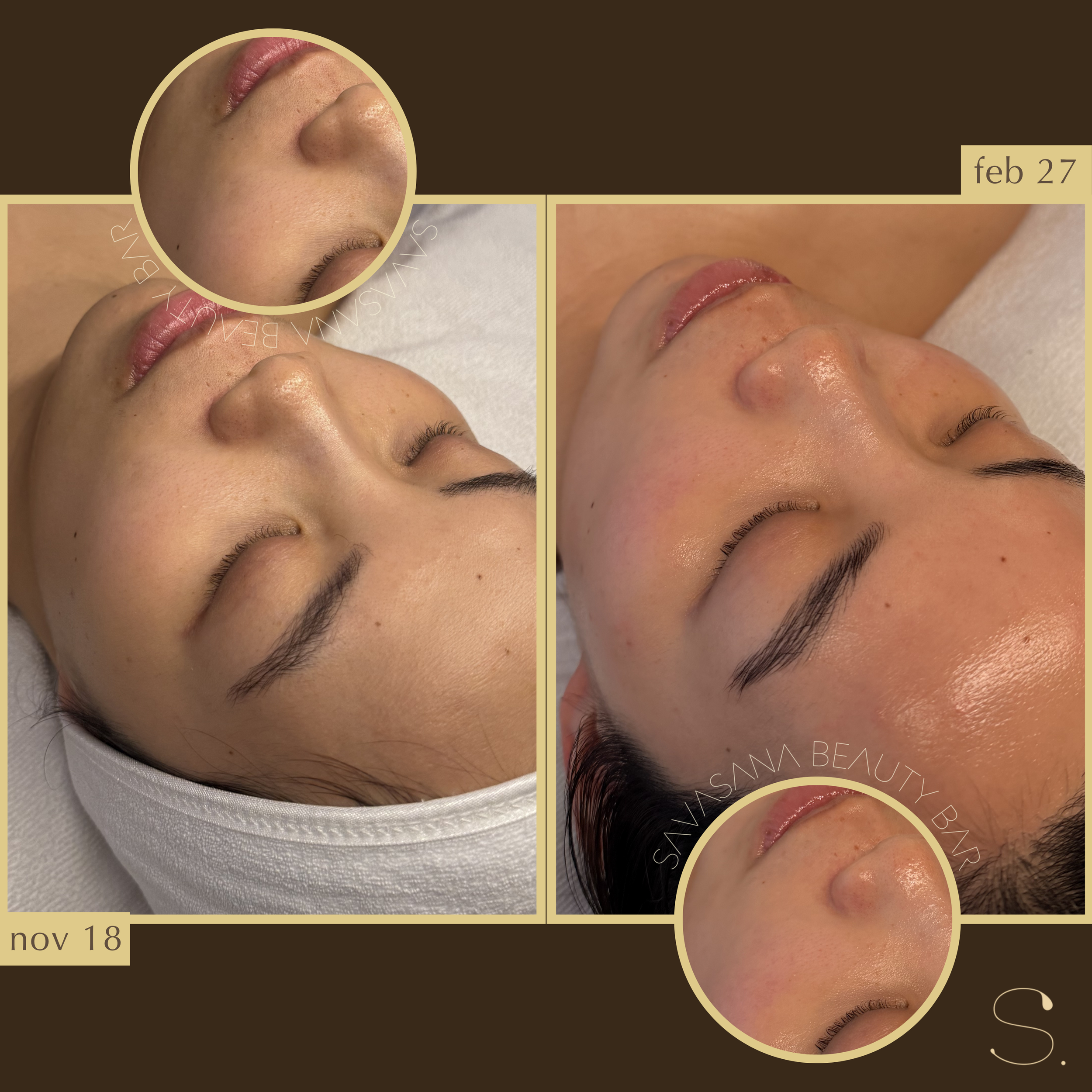 facials
