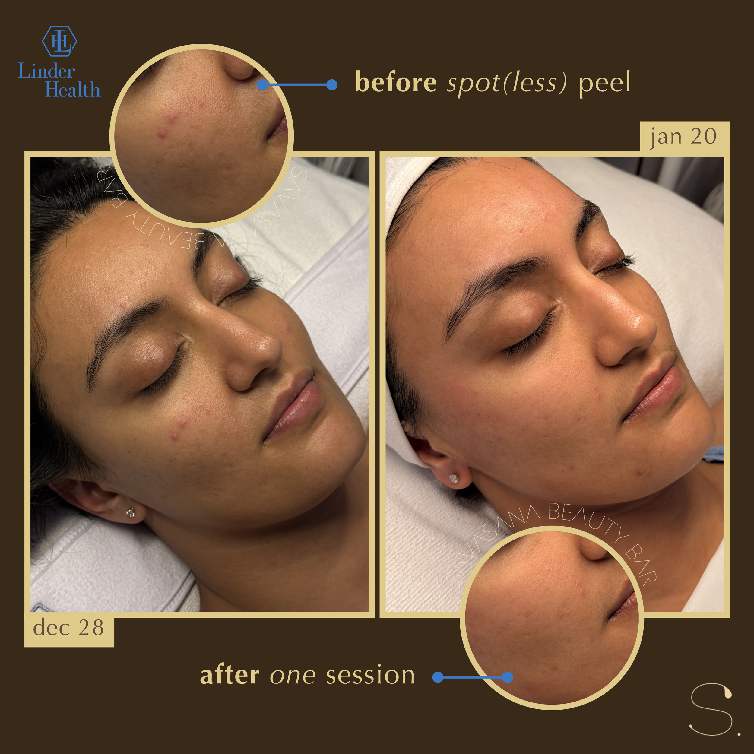 chemical peels x facials