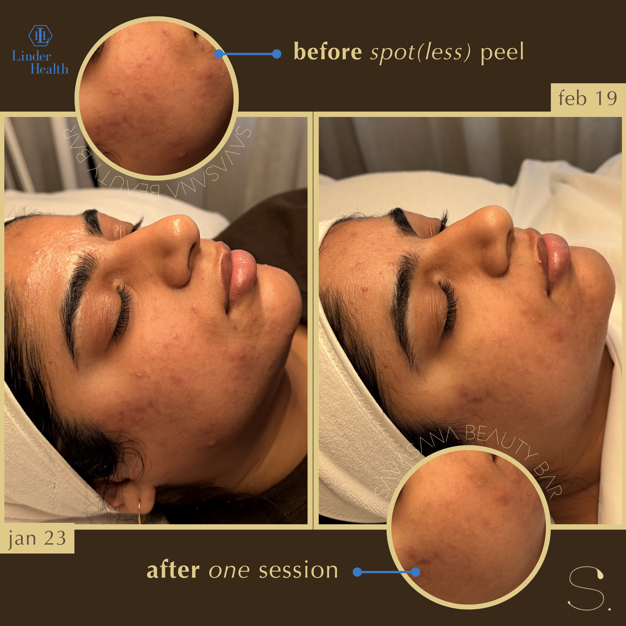 chemical peels x facials