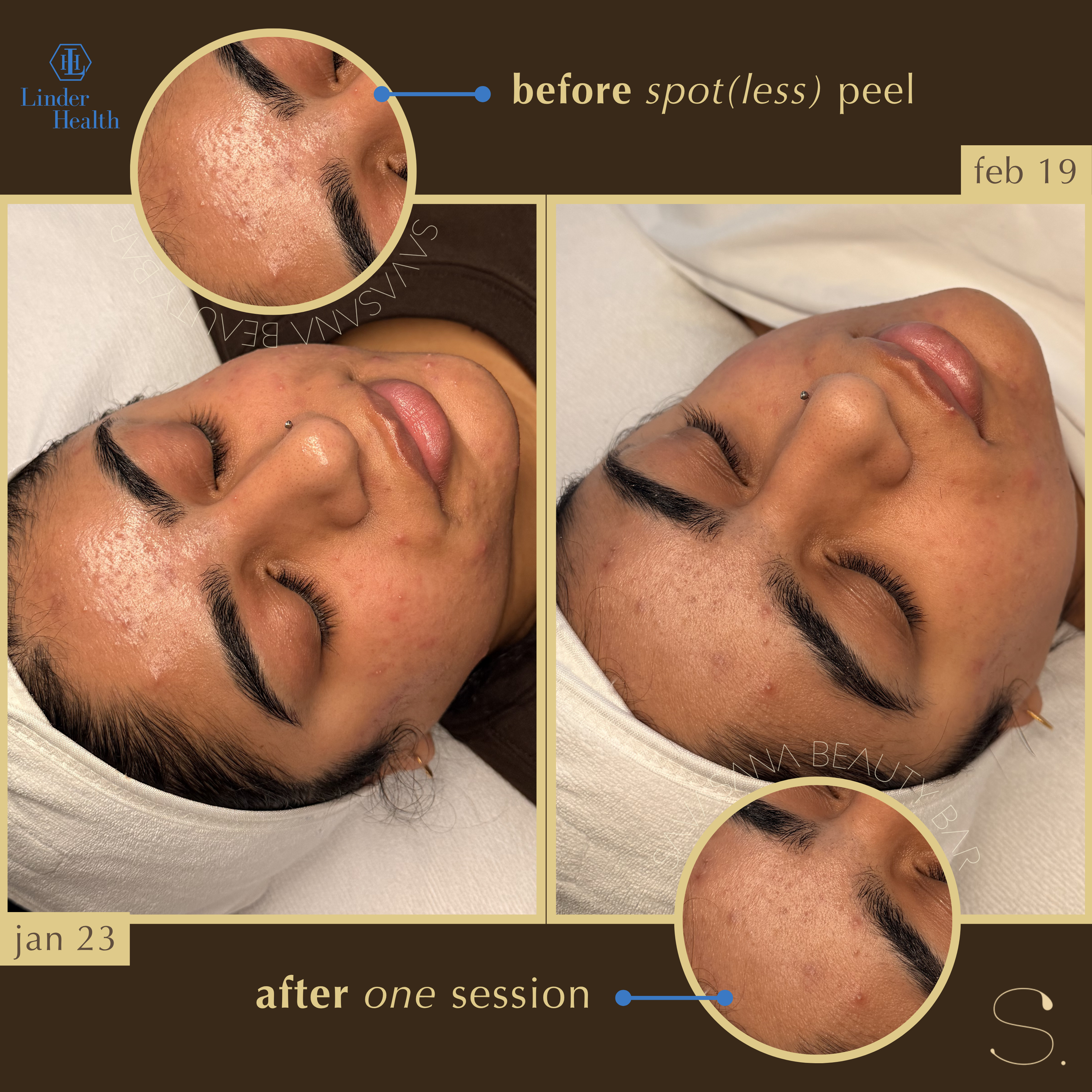 chemical peels x facials