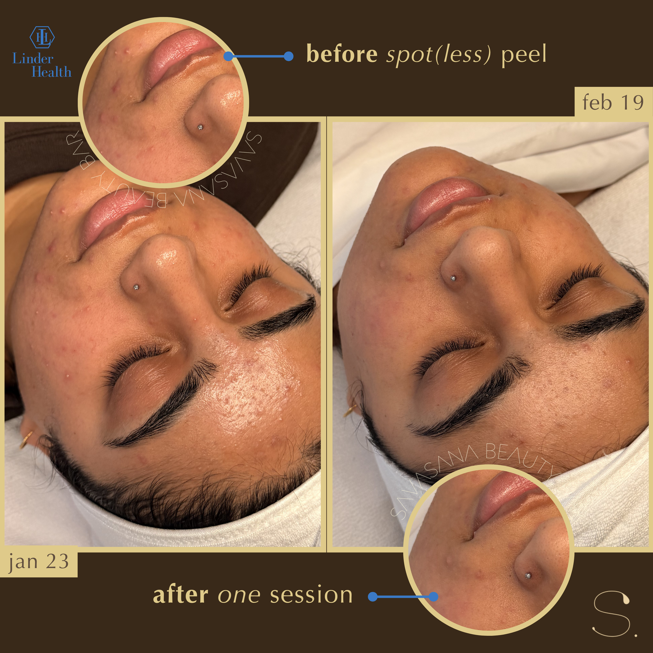 chemical peels x facials