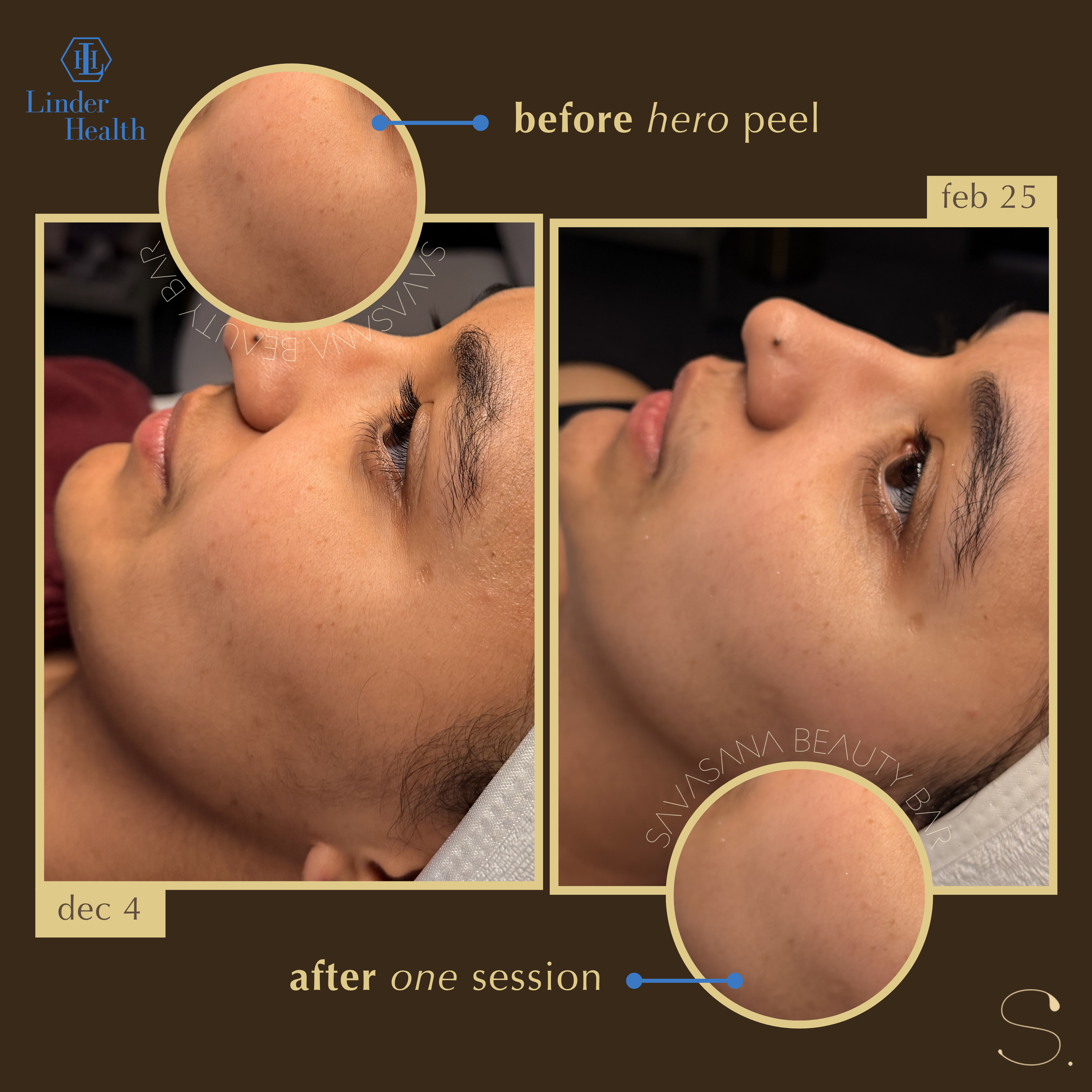 chemical peels x facials