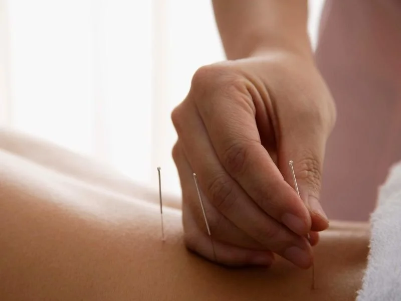 A person receiving acupuncture treatment with thin needles inserted into their back.