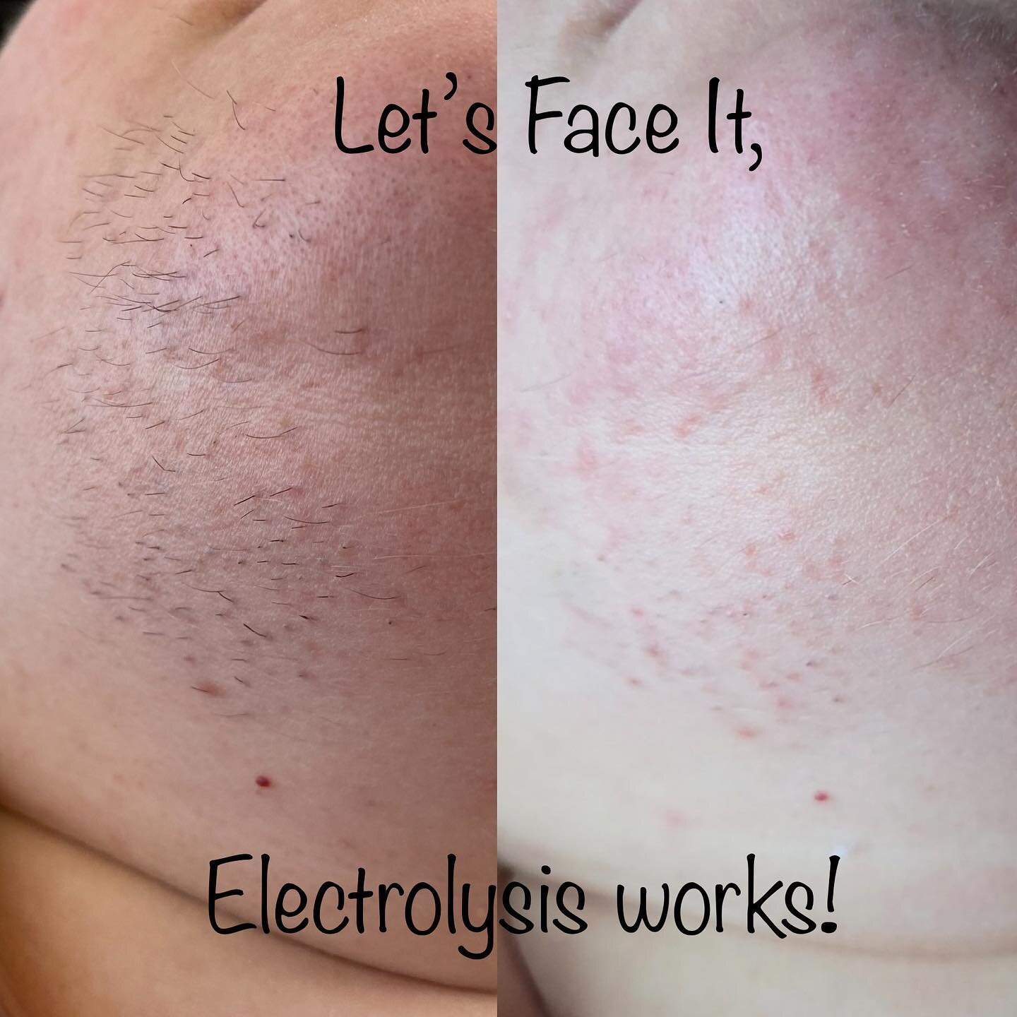 @belleville.electrolysis.laser we offer permanent hair removal by Electrolysis! This stuff works, simply put! Essentially we cauterize the blood supply to the root of the hair and the hair simply can not come back! Every hair needs to be treated 6-8 