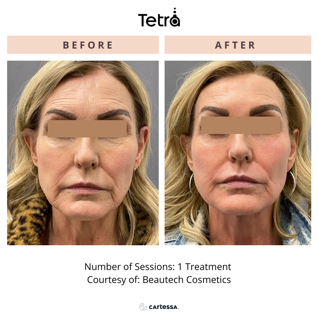 Comparison of a woman's face before and after a Tetra Pro CO2 cosmetic treatment, showing reduced wrinkles and improved skin tone.