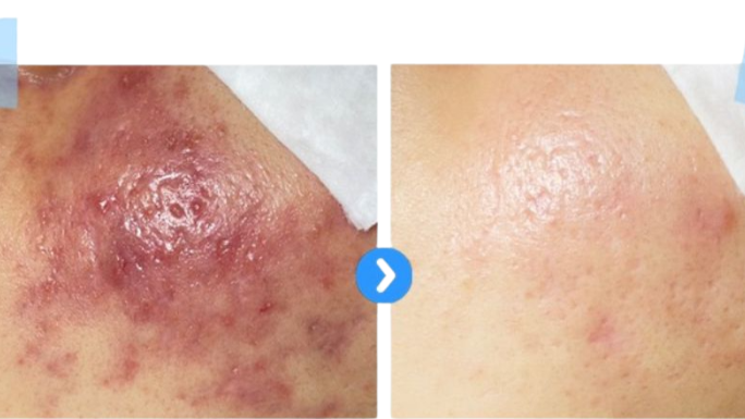 Before and after blue spirulina peel results showing significant reduction in breakouts, redness and post-inflammatory erythema.
