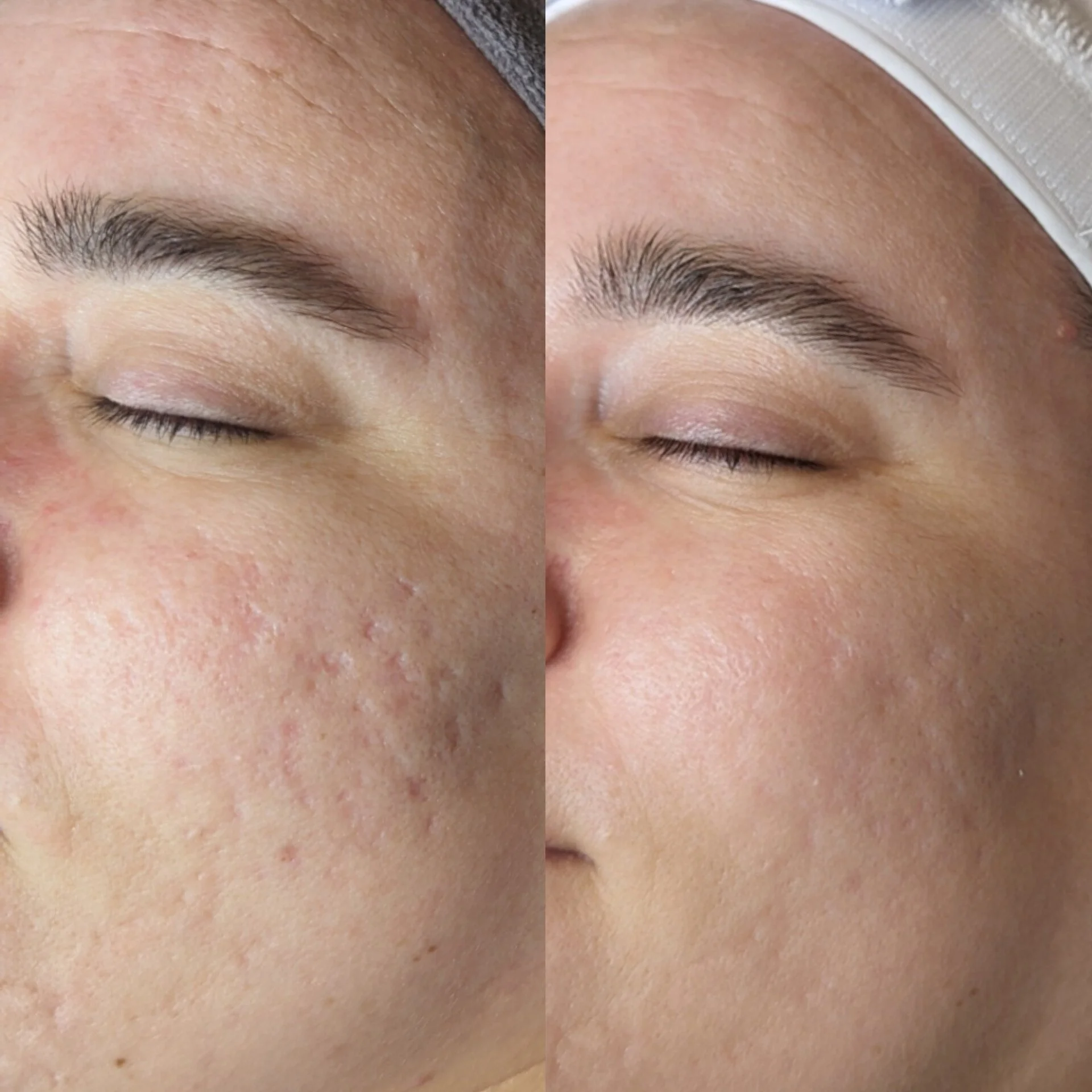 Before and after microneedling treatment comparison showing significant reduction in deep acne scarring and smoother cheek texture after 4 sessions.