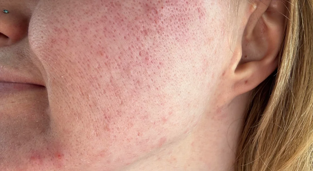 The DIY Trap: 3 Science-Backed Reasons to Skip At-Home Microneedling