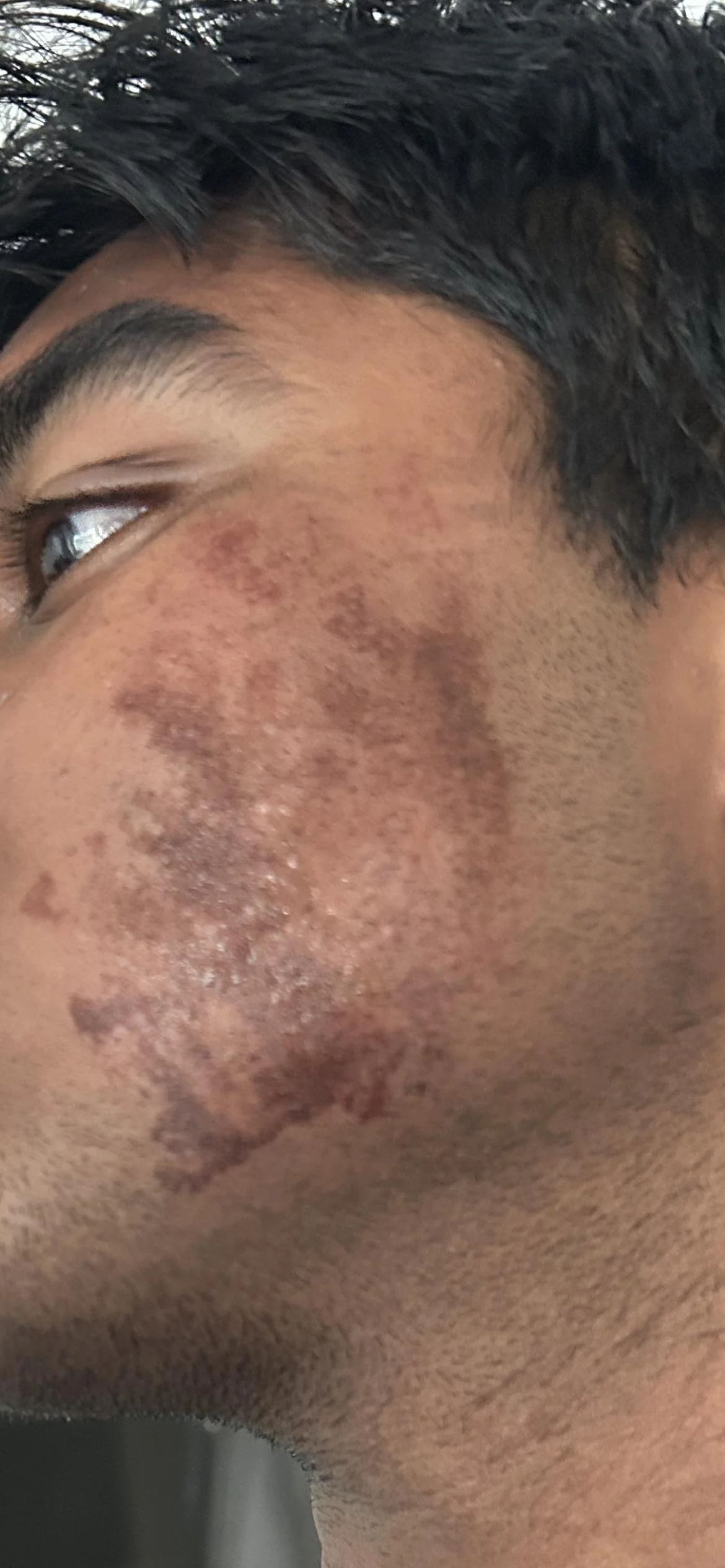 Chemical Burns &amp; FDA Warnings: The Hidden Dangers of DIY Chemical Peels