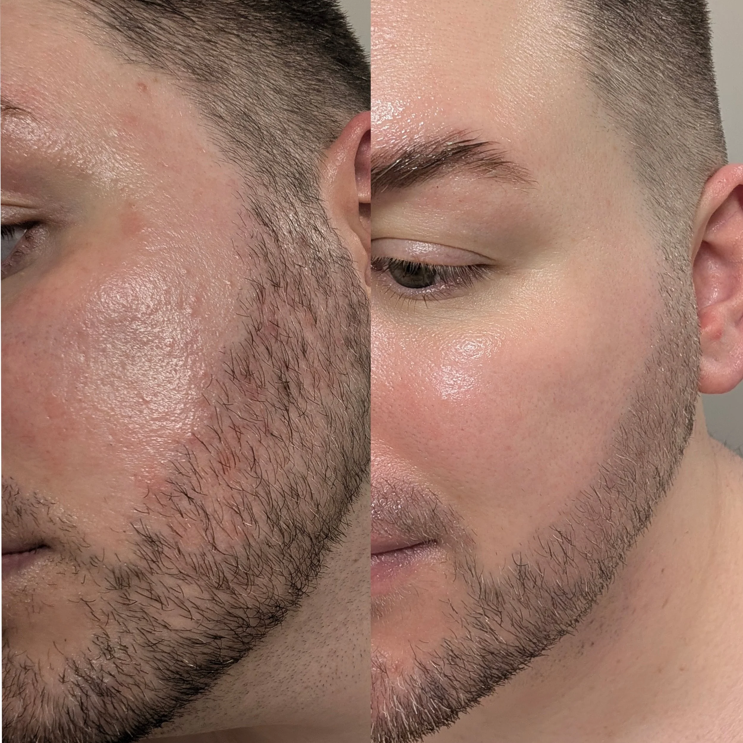Blue spirulina peel before and after results for acne and redness, demonstrating calmer, clearer skin texture and reduced inflammation.