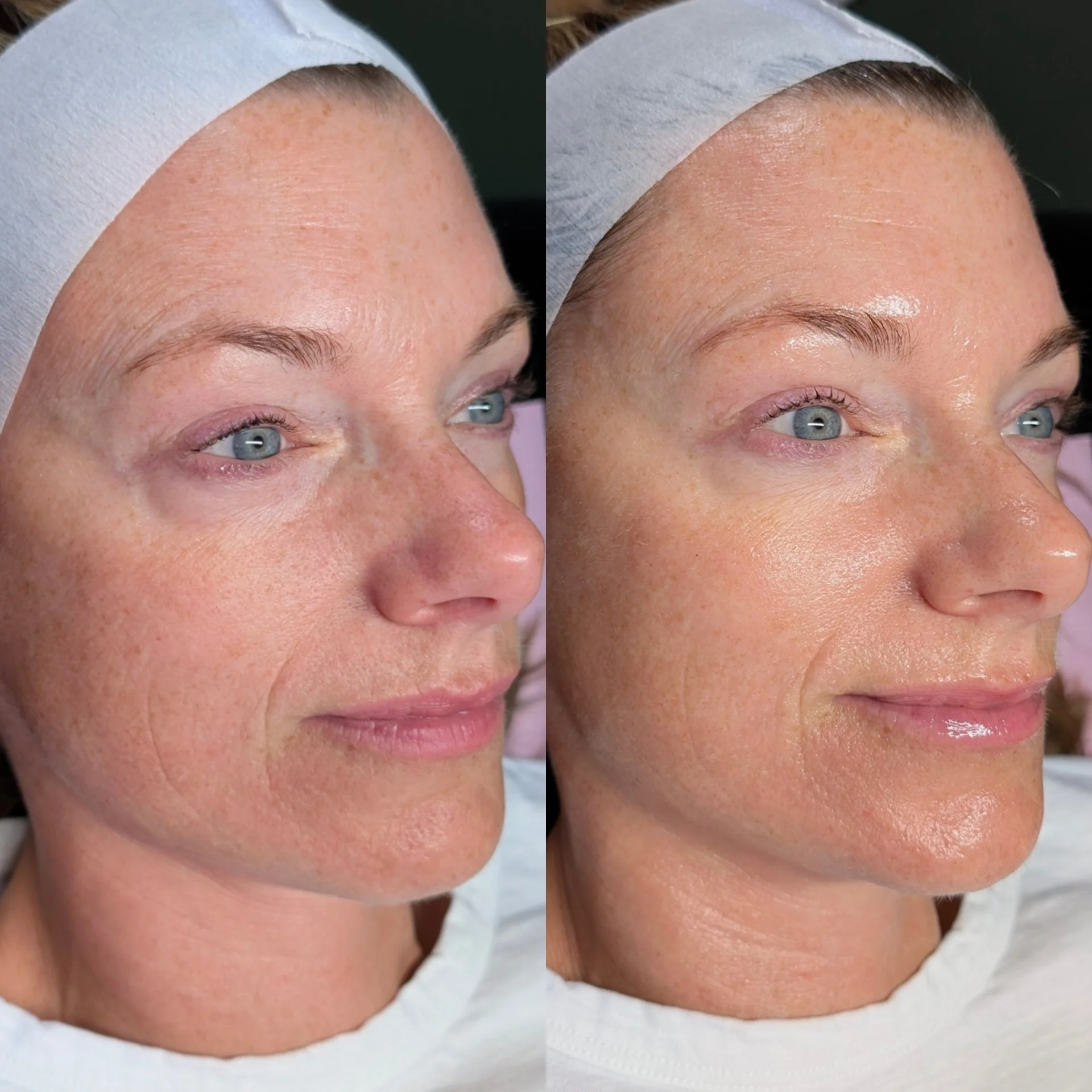 Side-by-side before and after Aqua Peel photo showing smoother skin texture, enhanced plumpness, and a glass-skin glow.