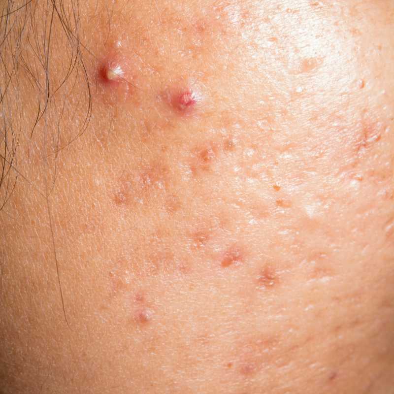 Close-up of a cheek showing red breakouts and clogged pores on acne-prone skin.