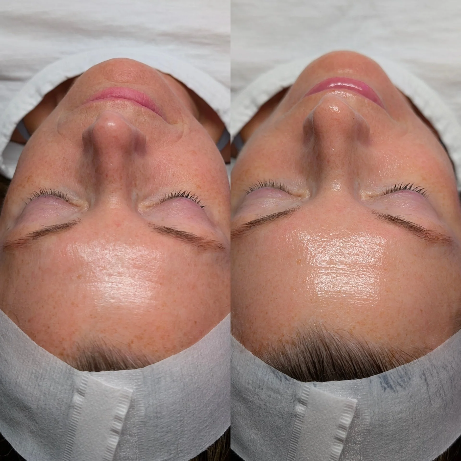 Before and after microneedling results showing softened fine lines, plumped skin, and reduced red spots around the cheeks and eyes.