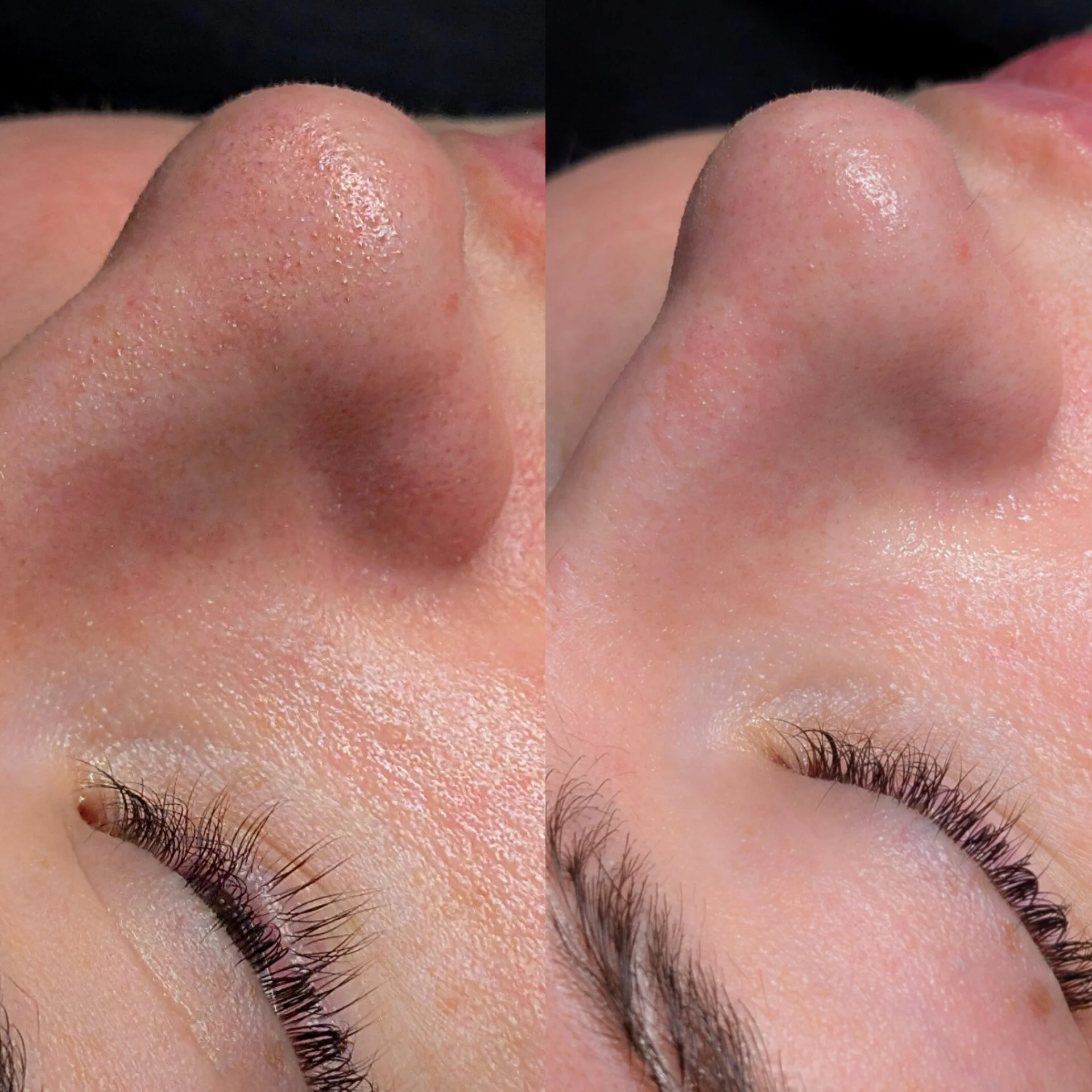 Before and after close-up of a nose showing congested pores and blackheads transformed into clean, decongested, smooth skin after an Aqua Peel hydrodermabrasion treatment.