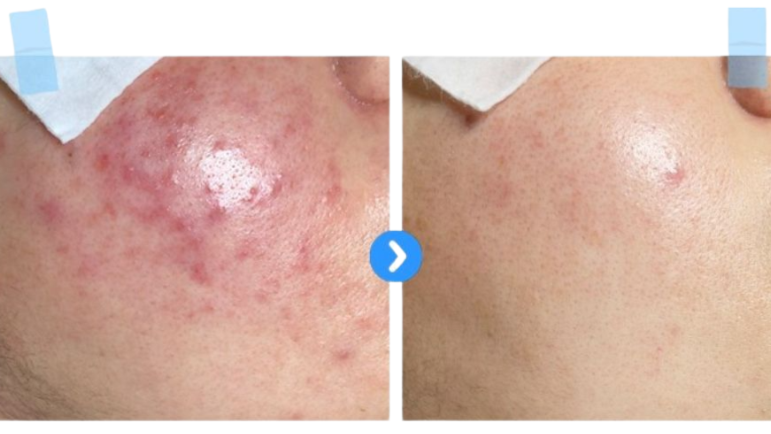Before and after blue spirulina peel treatment comparison showing significant reduction in blemishes and redness after 1 session.