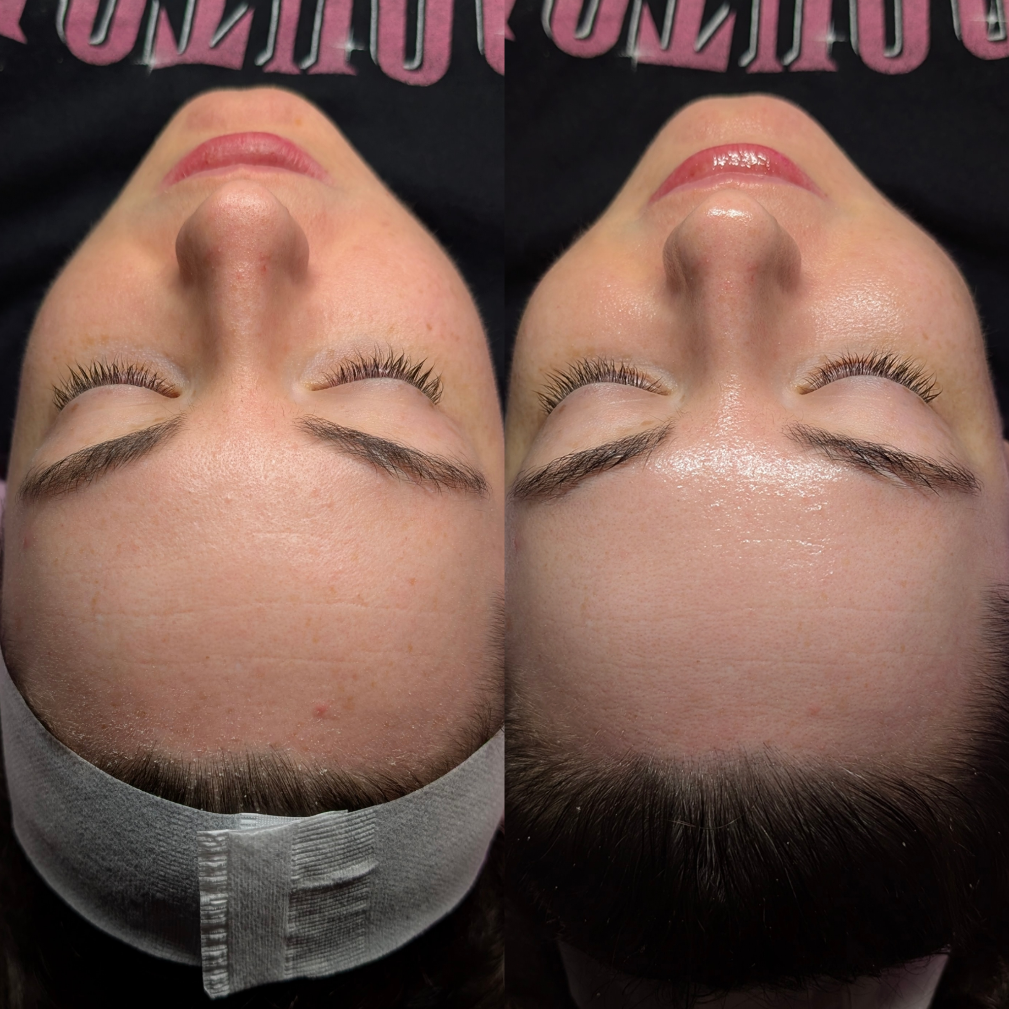 Before and after facial comparison showing dull, dry skin transformed into a smooth, plump, radiant, deeply hydrated glow following an Aqua Peel treatment.