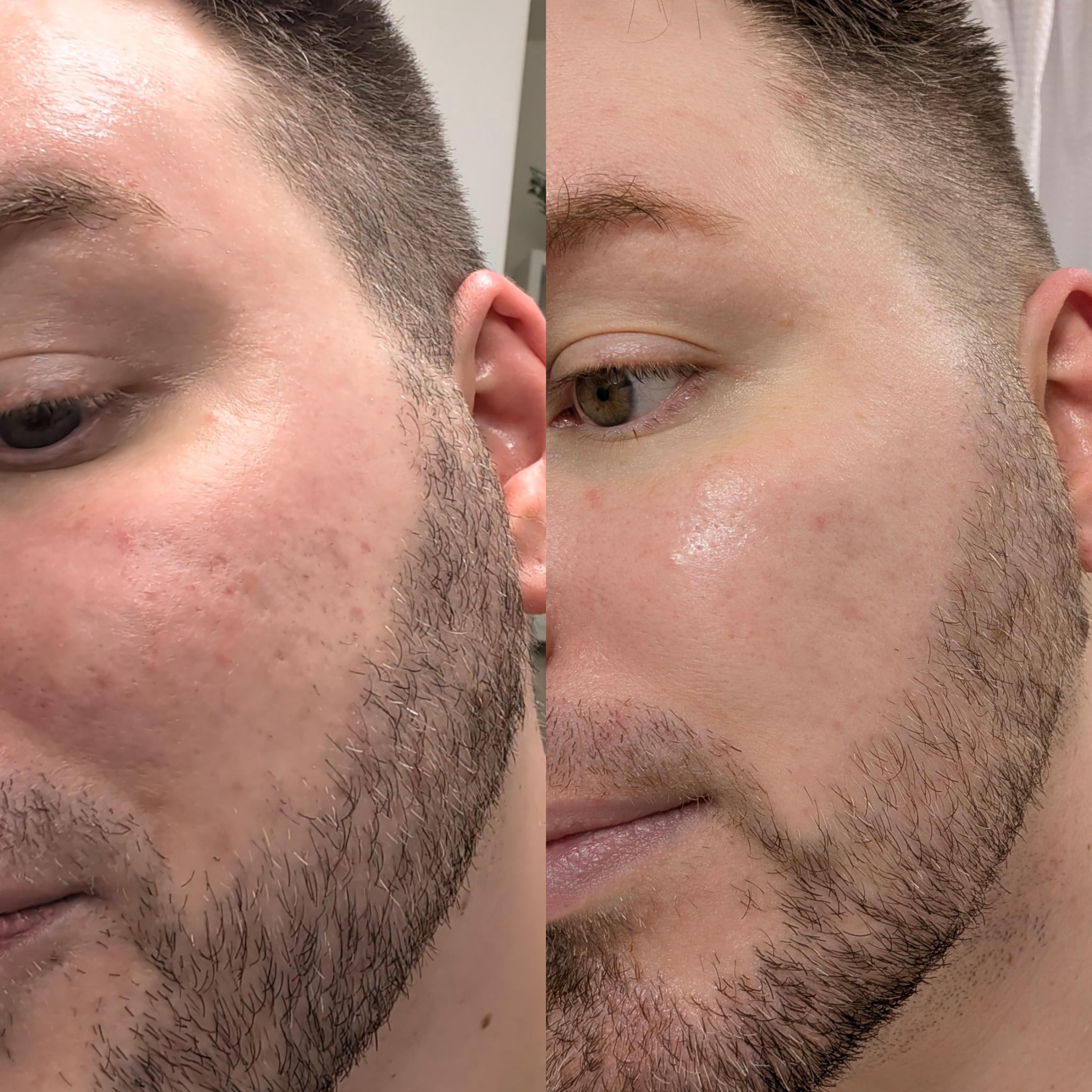 Before and after microneedling results showing reduced male acne scarring and smoother skin texture.